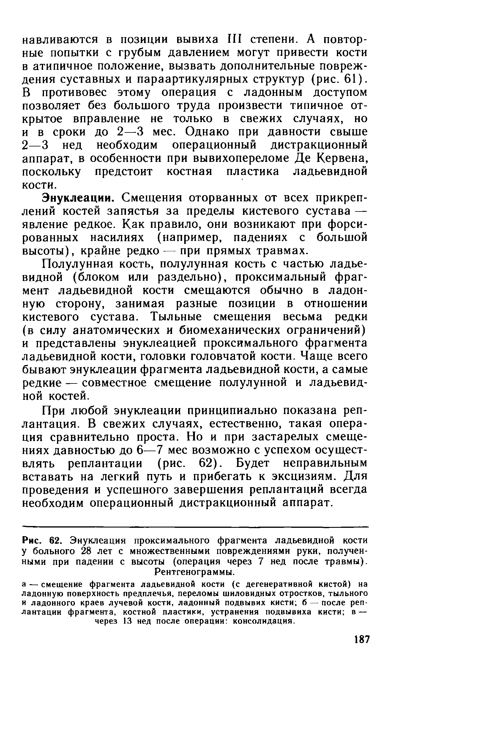 Рис. 62. Энуклеация проксимального фрагмента ладьевидной кости у больного 28 лет с множественными повреждениями руки, полученными при падении с высоты (операция через 7 нед после травмы). Рентгенограммы.