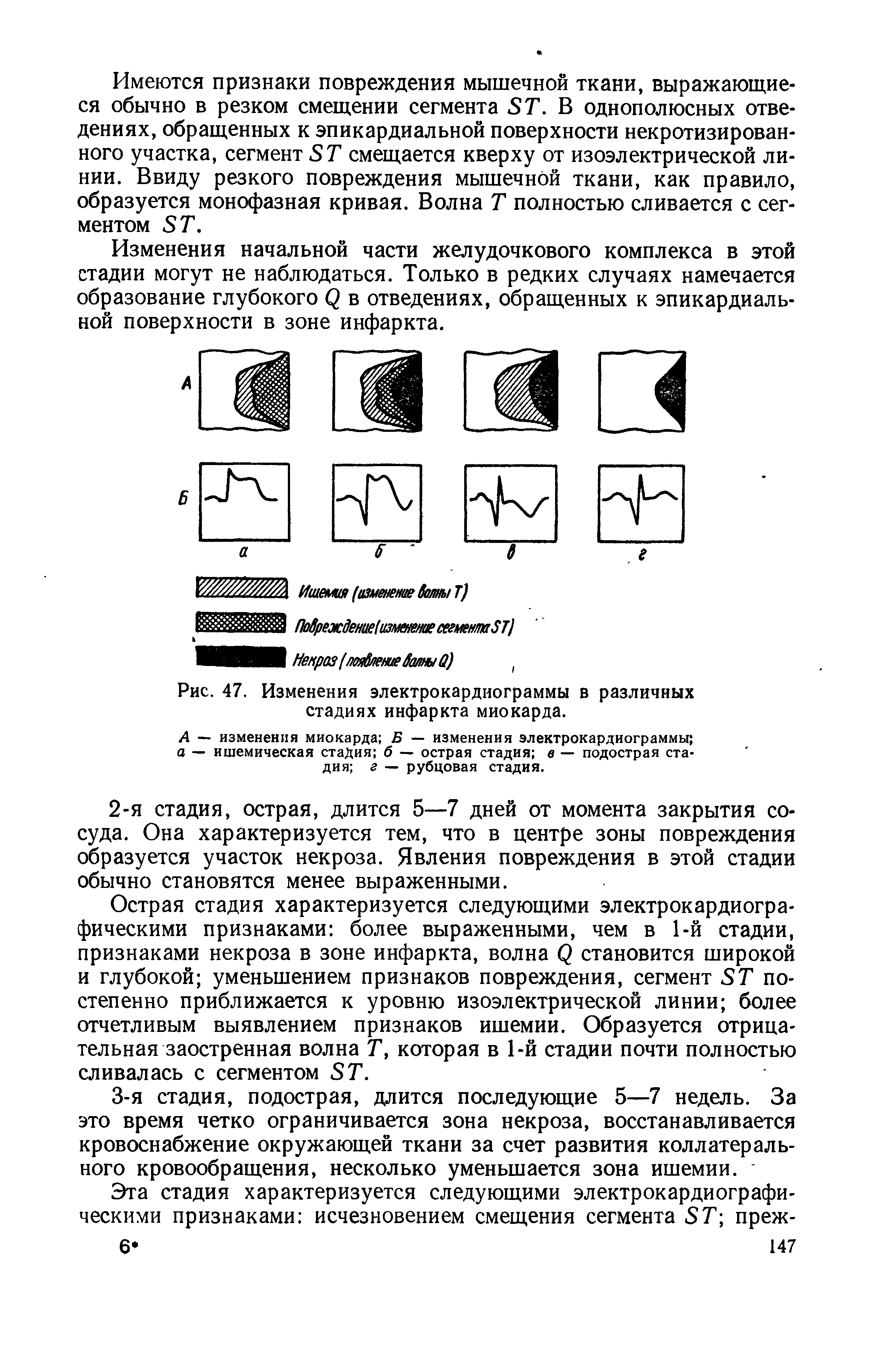 Рис. 47. Изменения электрокардиограммы в различных стадиях инфаркта миокарда.