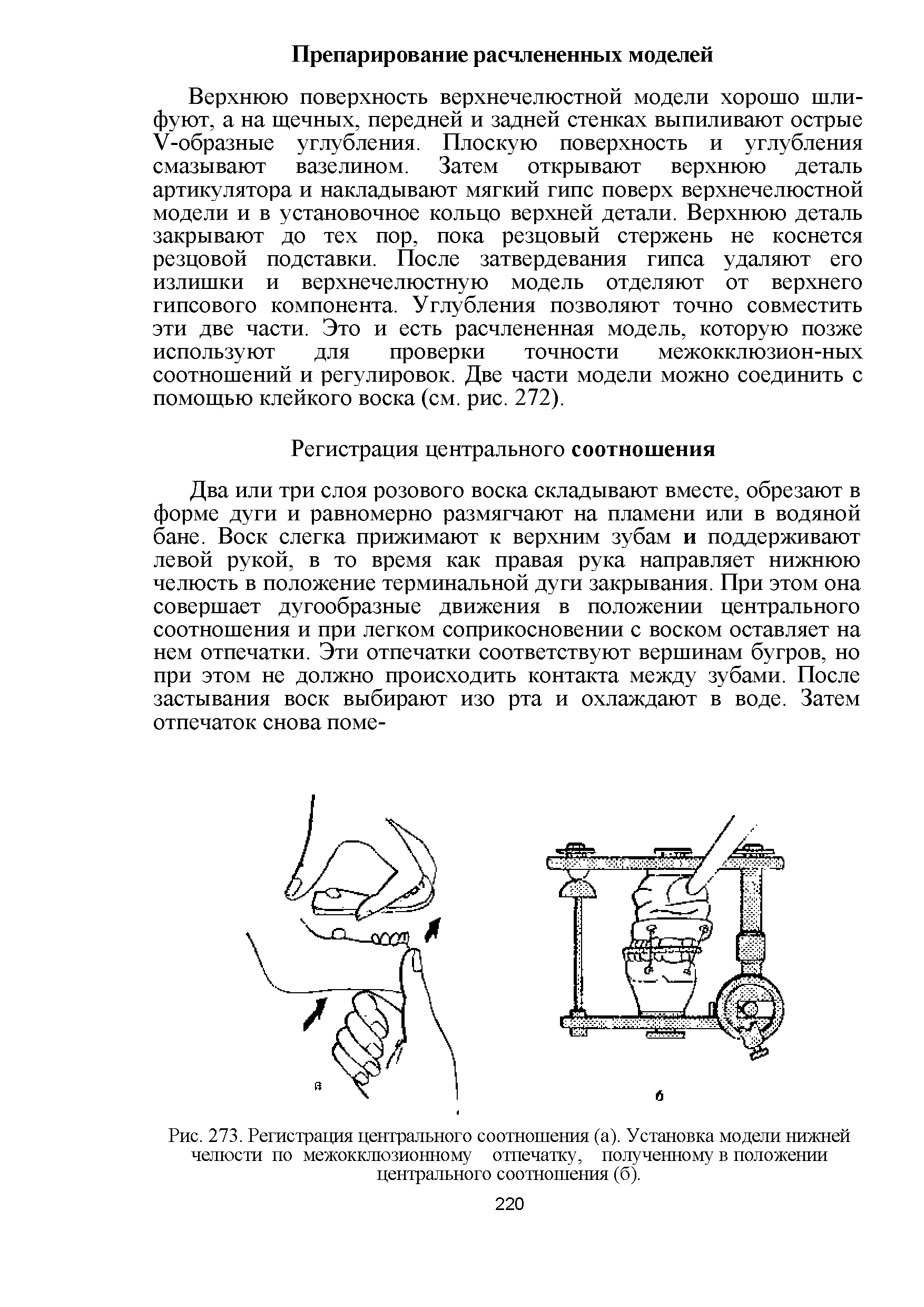 Рис. 273. Регистрация центрального соотношения (а). Установка модели нижней челюсти по межокклюзионному отпечатку, полученному в положении центрального соотношения (б).