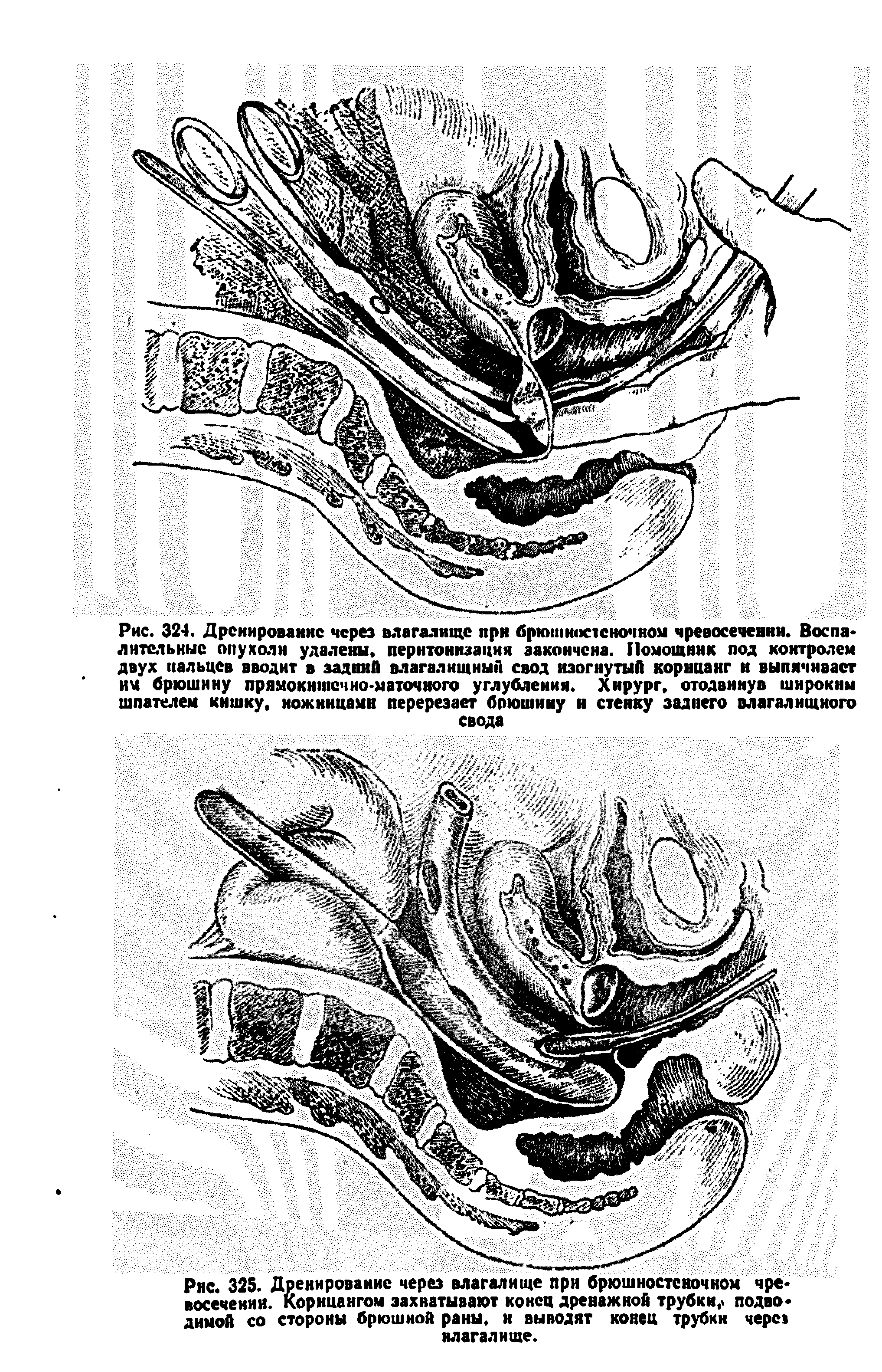 Рис. 325. Дренирование через влагалище при брюшностеночном чре восечении. Корнцангом захватывают конец дренажной трубки, подводимой со стороны брюшной раны, и выводят конец трубки через влагалище.