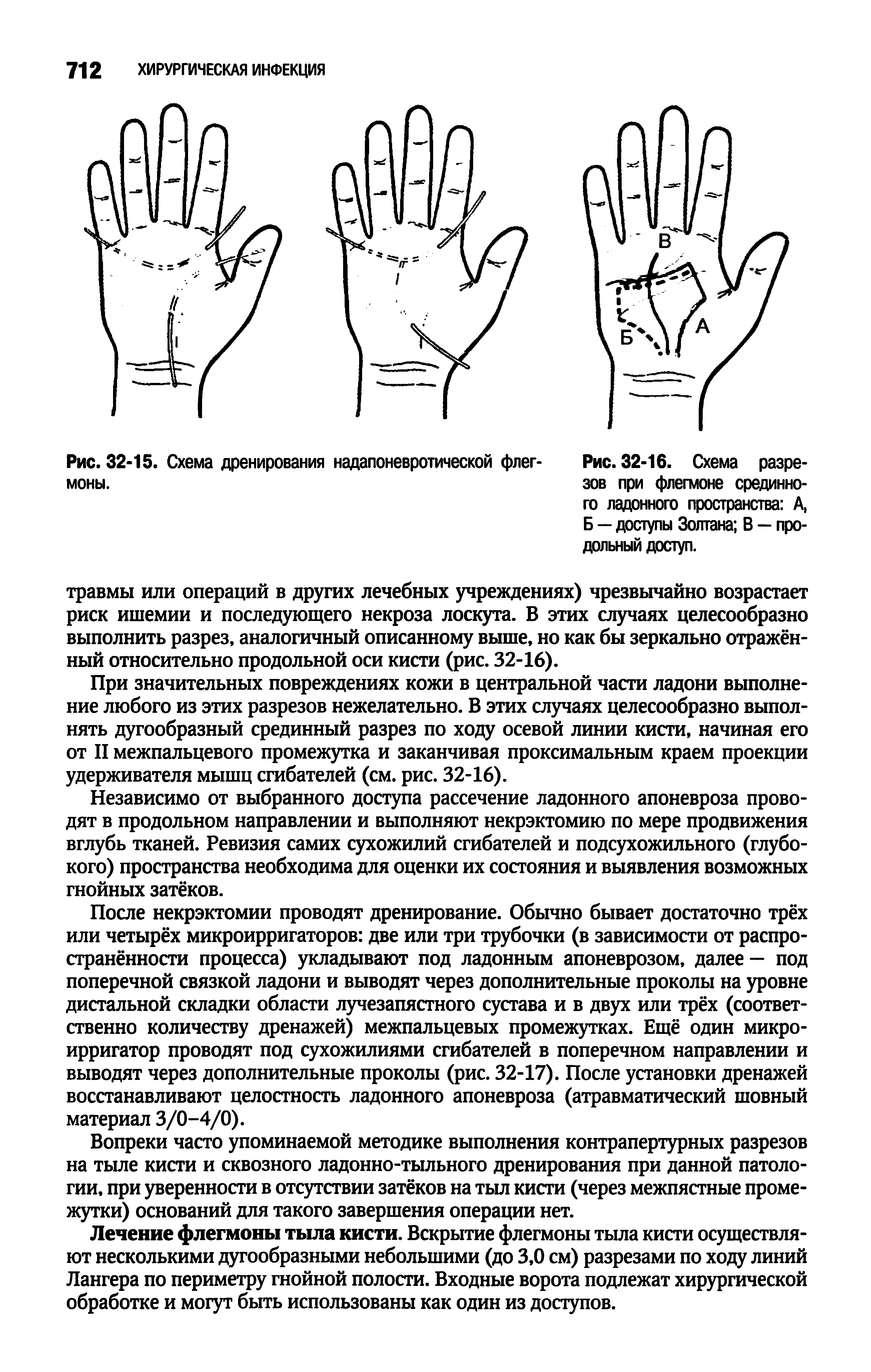 Рис. 32-16. Схема разрезов при флегмоне срединного ладонного пространства А, Б — доступы Золтана В — продольный доступ.