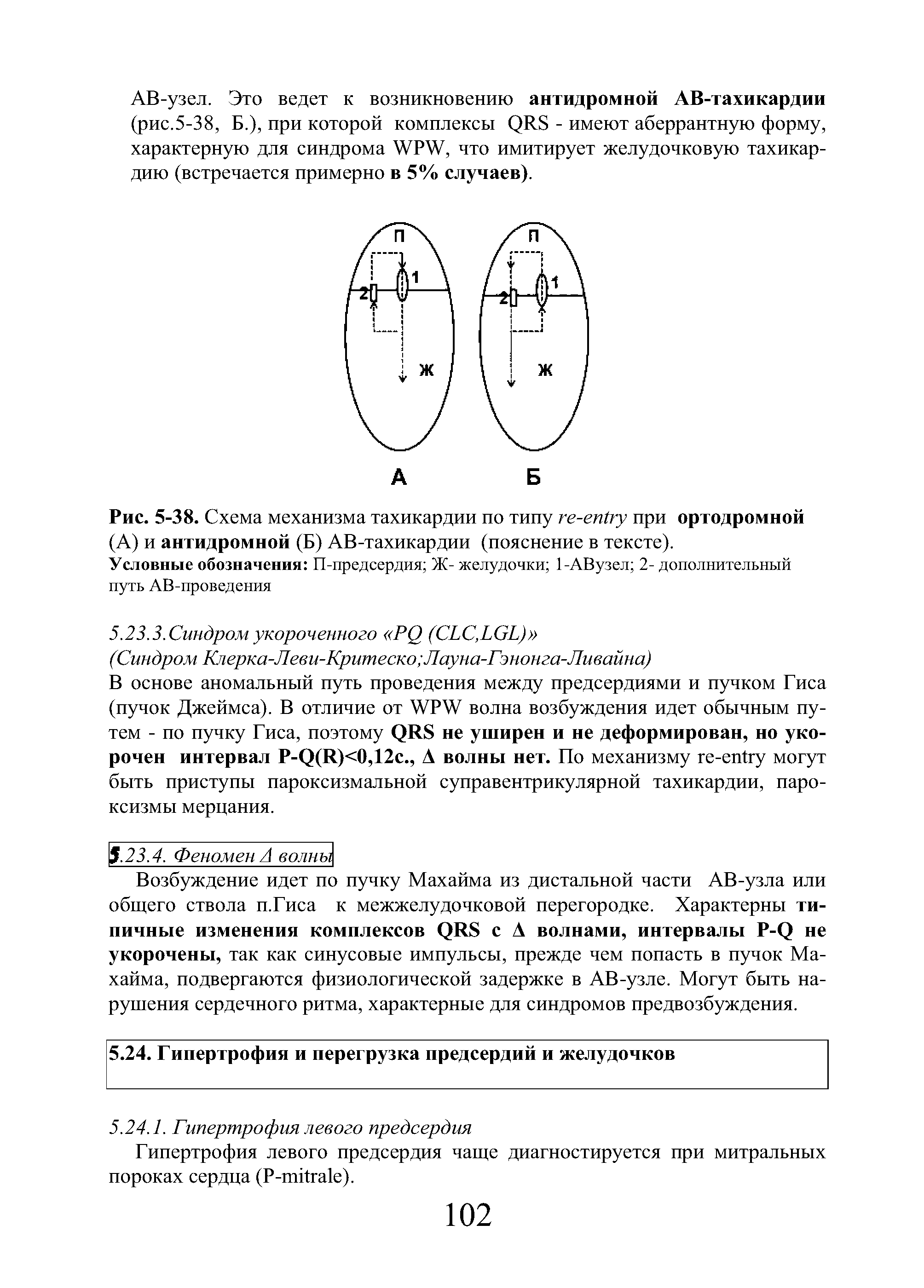 Рис. 5-38. Схема механизма тахикардии по типу - при ортодромной (А) и антидромной (Б) АВ-тахикардии (пояснение в тексте).