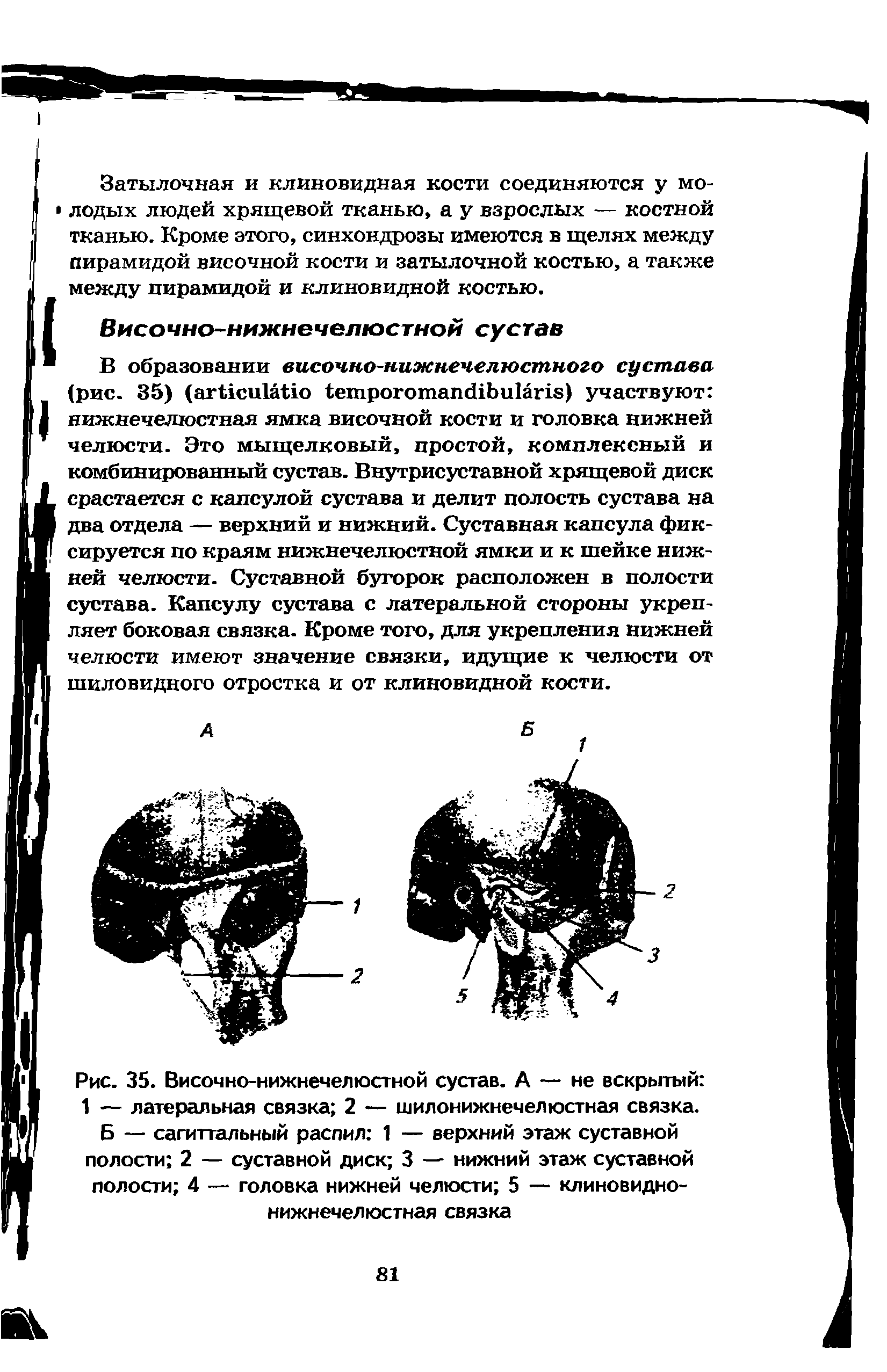 Рис. 35. Височно-нижнечелюстной сустав. А — не вскрытый 1 — латеральная связка 2 — шилонижнечелюстная связка.