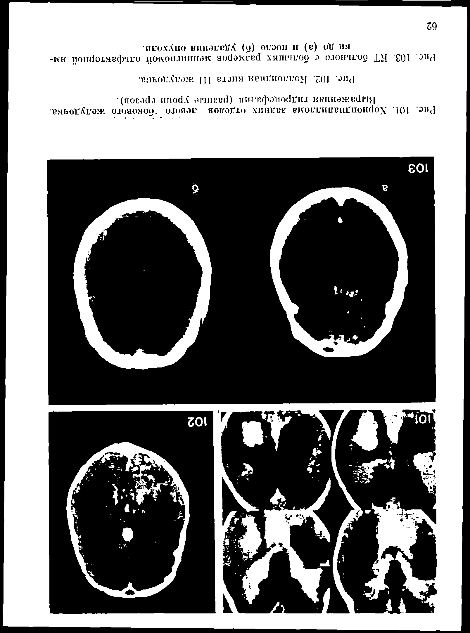 Рис. 103. КТ больного с больших размеров менингиомой ольфакторной ямки до (а) и после (б) удаления опухоли.