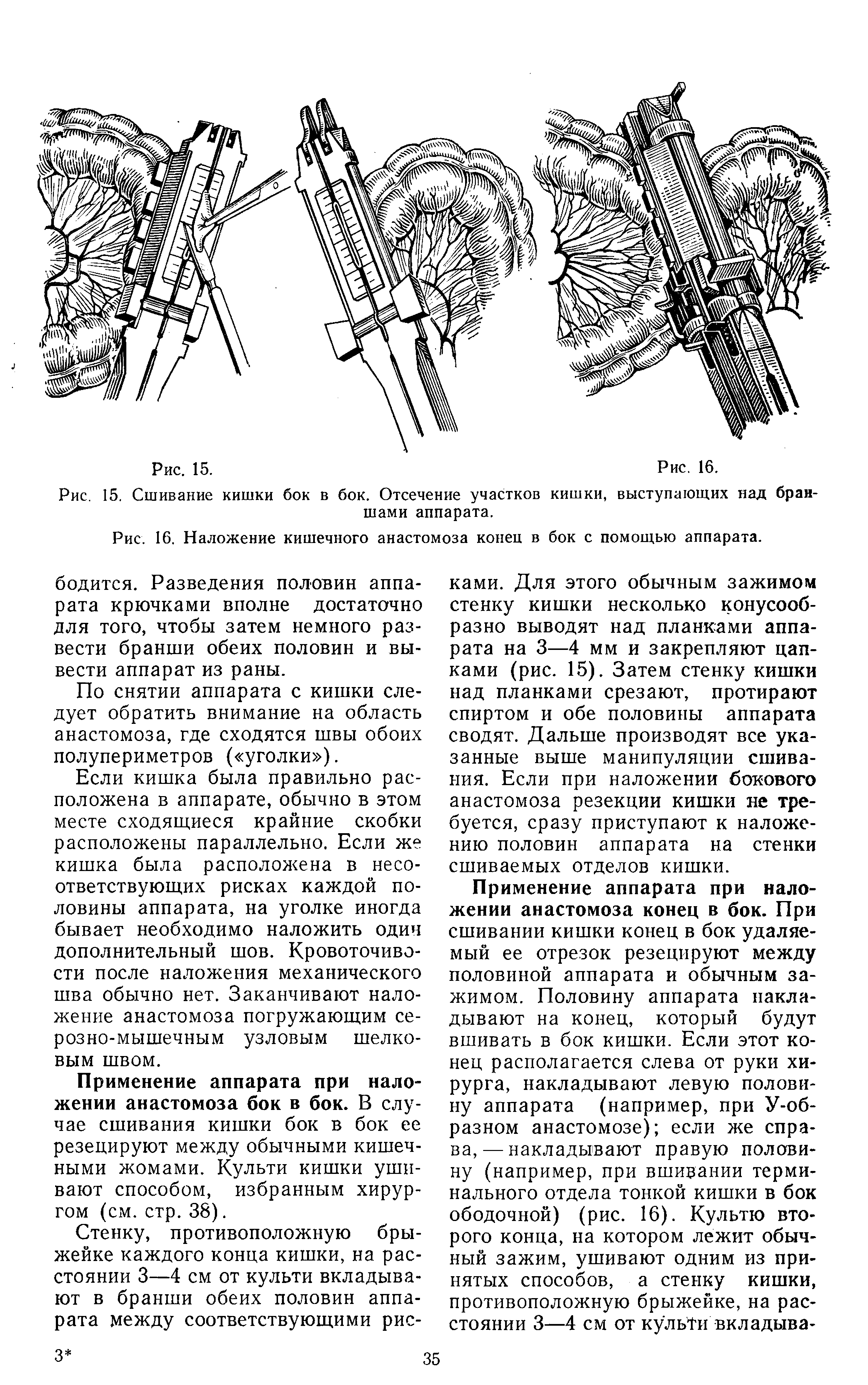 Рис. 16. Наложение кишечного анастомоза конец в бок с помощью аппарата.