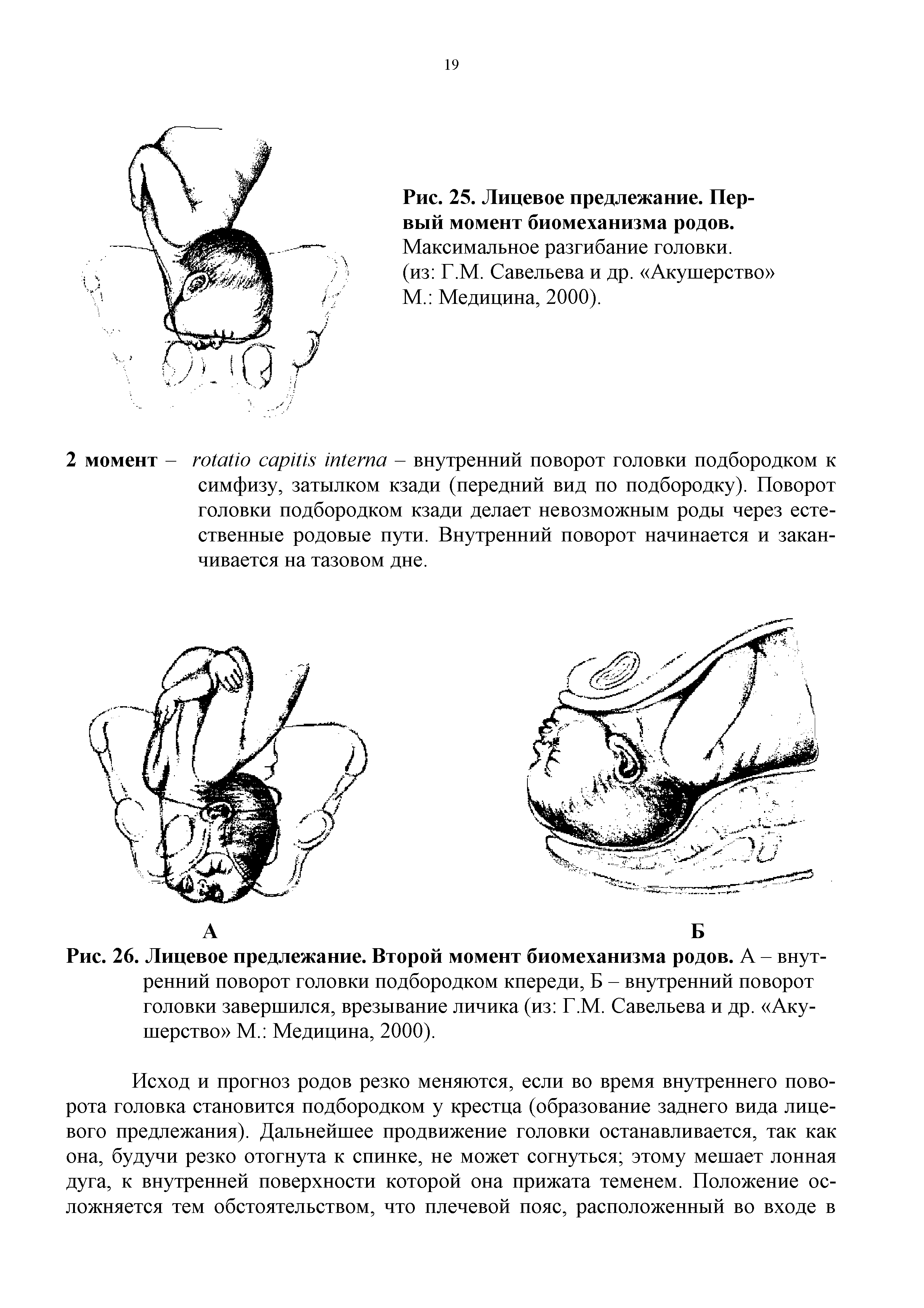 Рис. 26. Лицевое предлежание. Второй момент биомеханизма родов. А - внутренний поворот головки подбородком кпереди, Б - внутренний поворот головки завершился, врезывание личика (из Г.М. Савельева и др. Акушерство М. Медицина, 2000).