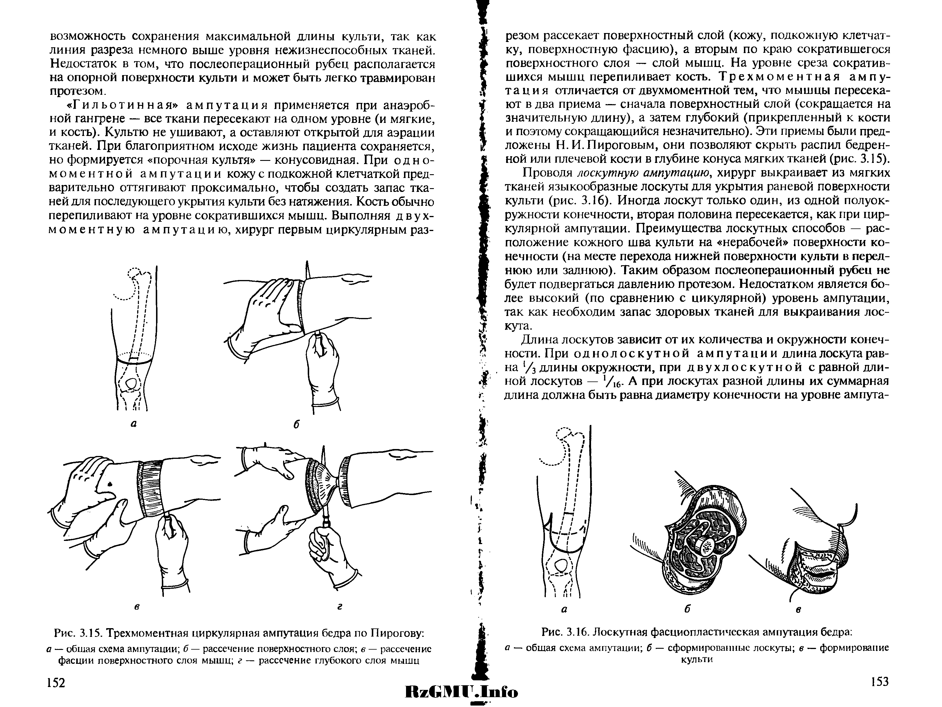 Рис. 3.15. Трехмоментная циркулярная ампутация бедра по Пирогову а — обшая схема ампутации б — рассечение поверхностного слоя в — рассечение фасции поверхностного слоя мышц г — рассечение глубокого слоя мышц...