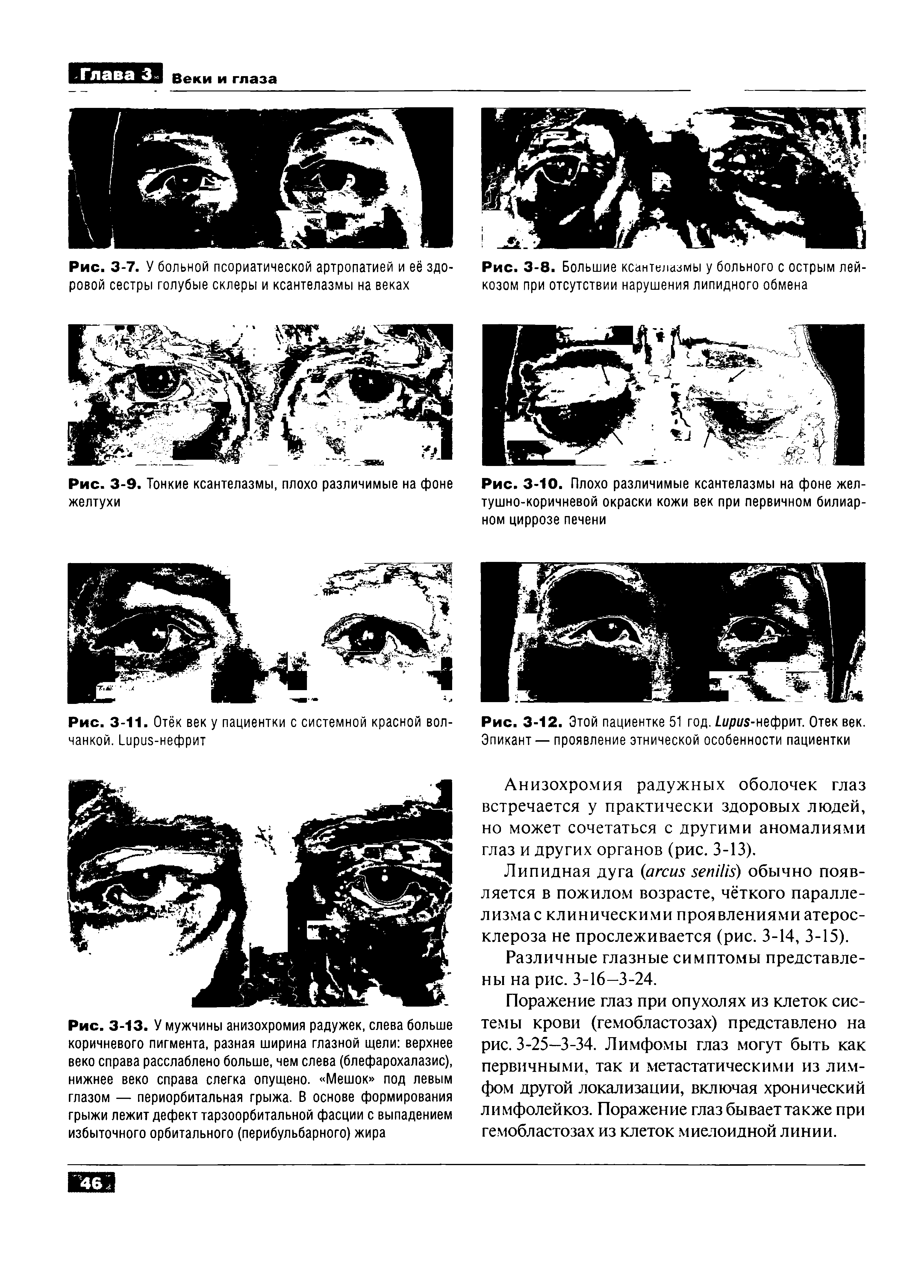 Рис. 3-12. Этой пациентке 51 год. //и/я-нефрит. Отек век. Эпикант — проявление этнической особенности пациентки...