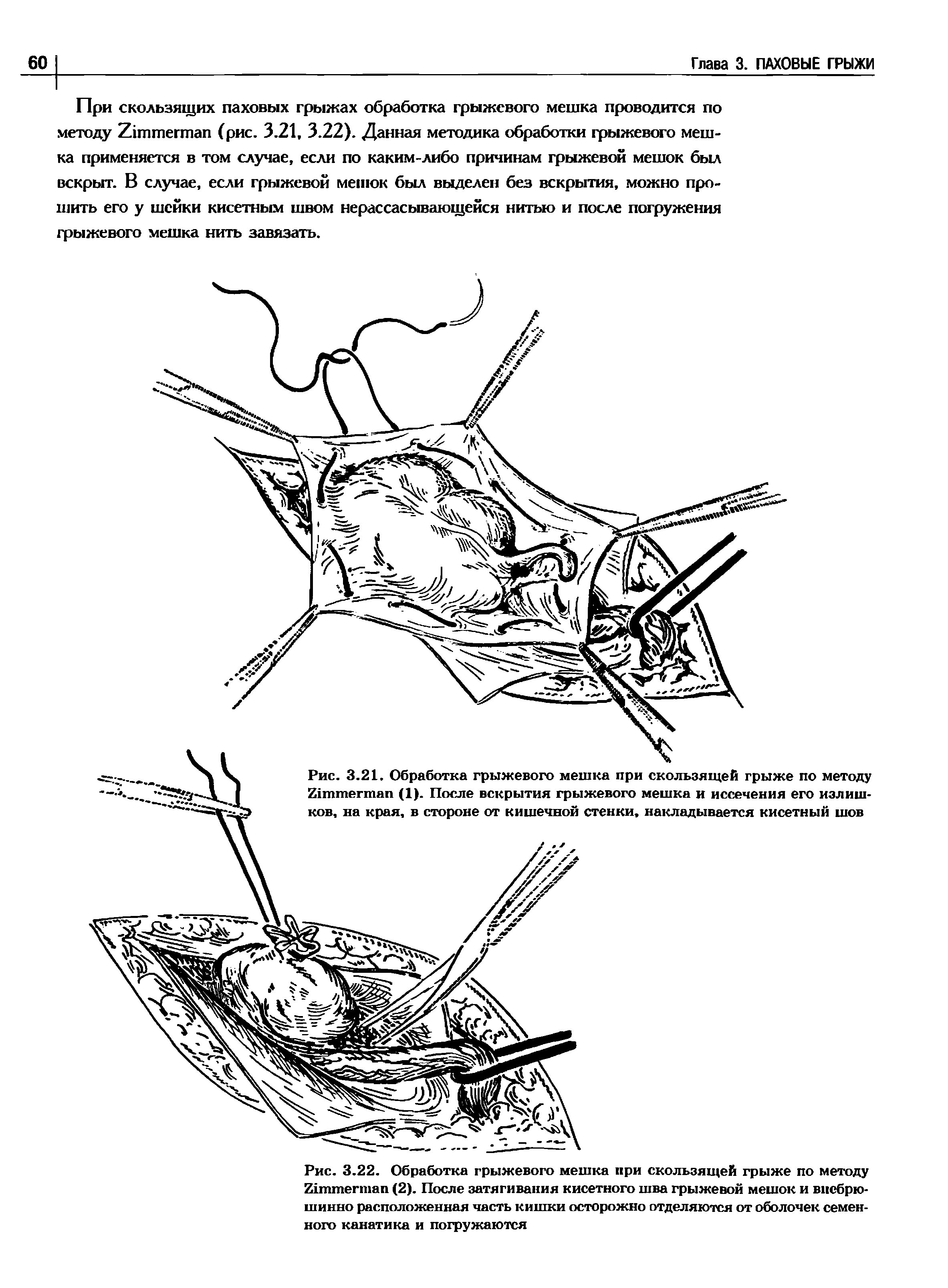 Рис. 3.22. Обработка грыжевого мешка при скользящей грыже по методу Z (2). После затягивания кисетного шва грыжевой мешок и впебрю-шинно расположенная часть кишки осторожно отделяются от оболочек семенного канатика и погружаются...