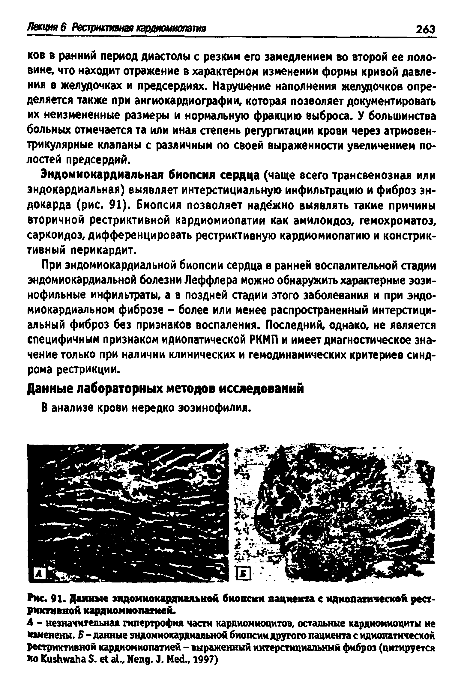 Рис. 91. Данные эндомиокардиальной биопсии пациента с идиопатической рестриктивной кардиомиопатией.