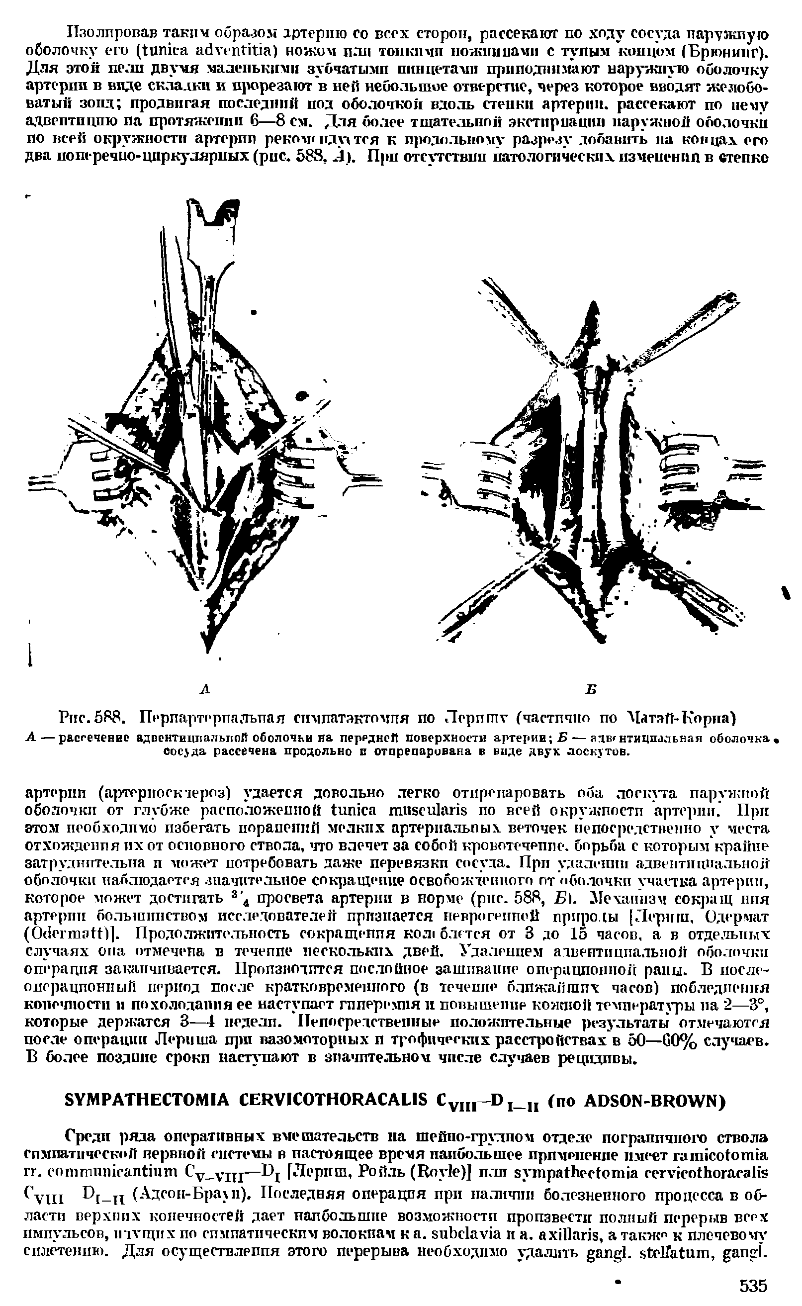 Рис. 588. Перпартерпалъпая симпатэктомия по Першит (частично по Матэй-Кориа)...
