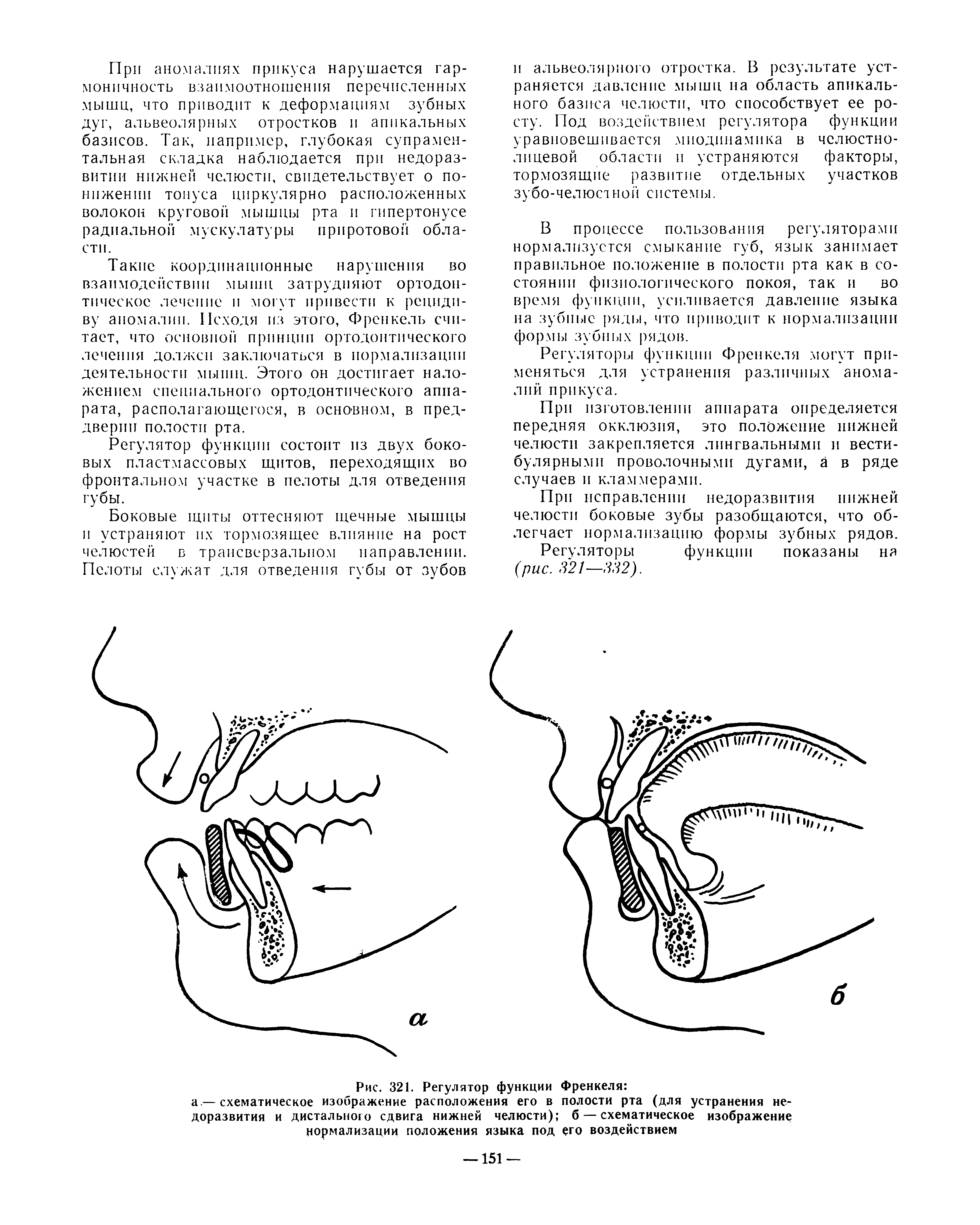 Рис. 321. Регулятор функции Френкеля а —схематическое изображение расположения его в полости рта (для устранения недоразвития и дистального сдвига нижней челюсти) б — схематическое изображение нормализации положения языка под его воздействием...