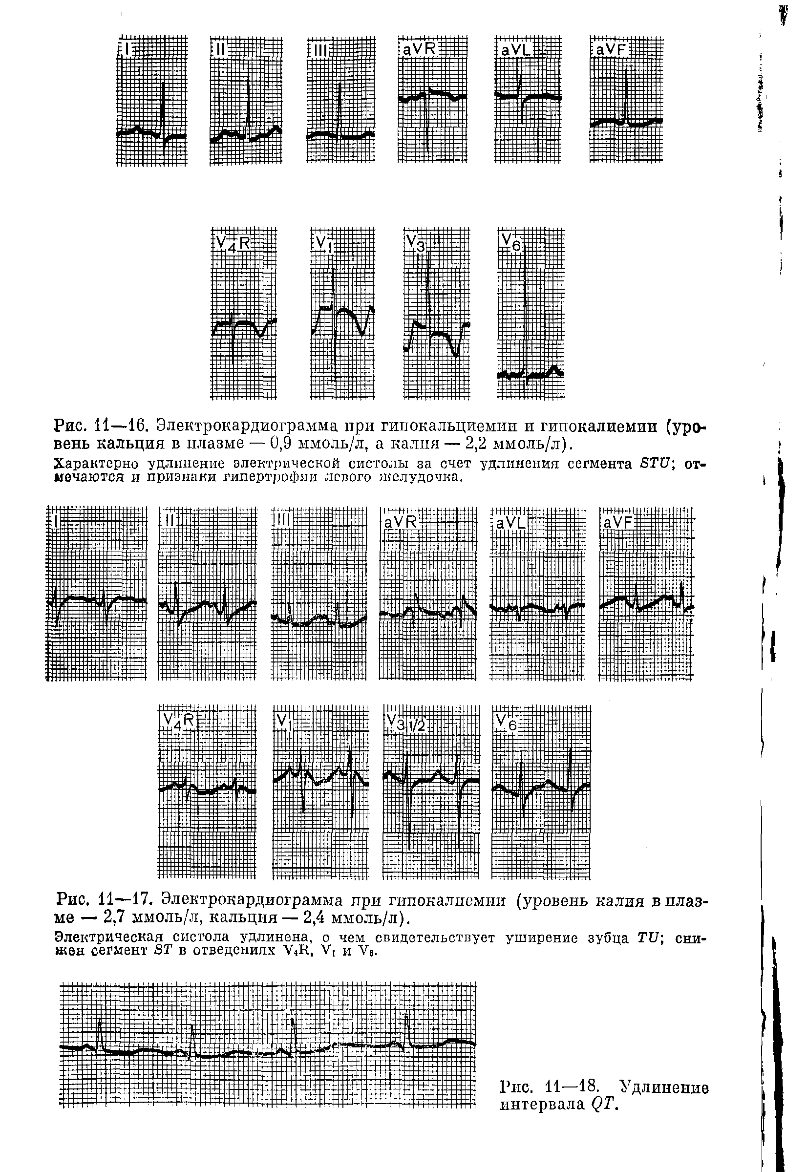 Рис. 11—17. Электрокардиограмма при гипокалиемии (уровень калия в плазме — 2,7 ммоль/л, кальция— 2,4 ммоль/л).