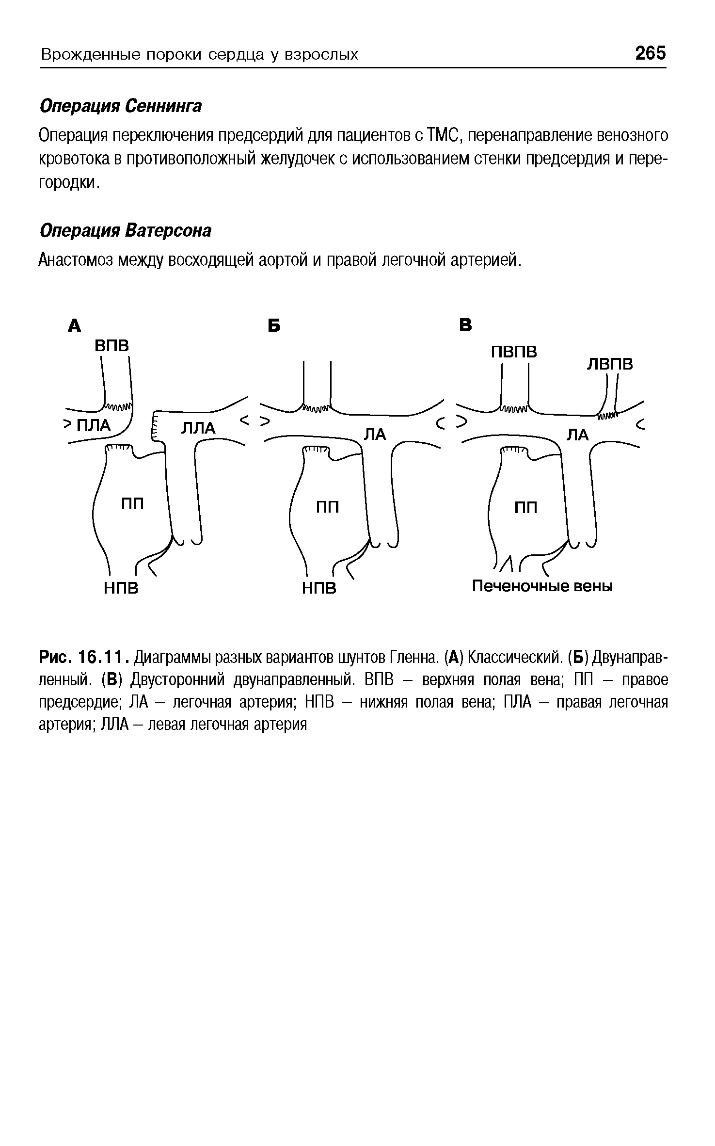 Рис. 16.11. Диаграммы разных вариантов шунтов Гленна. (А) Классический. (Б) Двунаправленный. (В) Двусторонний двунаправленный. ВПВ - верхняя полая вена ПП - правое предсердие ЛА - легочная артерия НПВ - нижняя полая вена ПЛА - правая легочная артерия ЛЛА - левая легочная артерия...