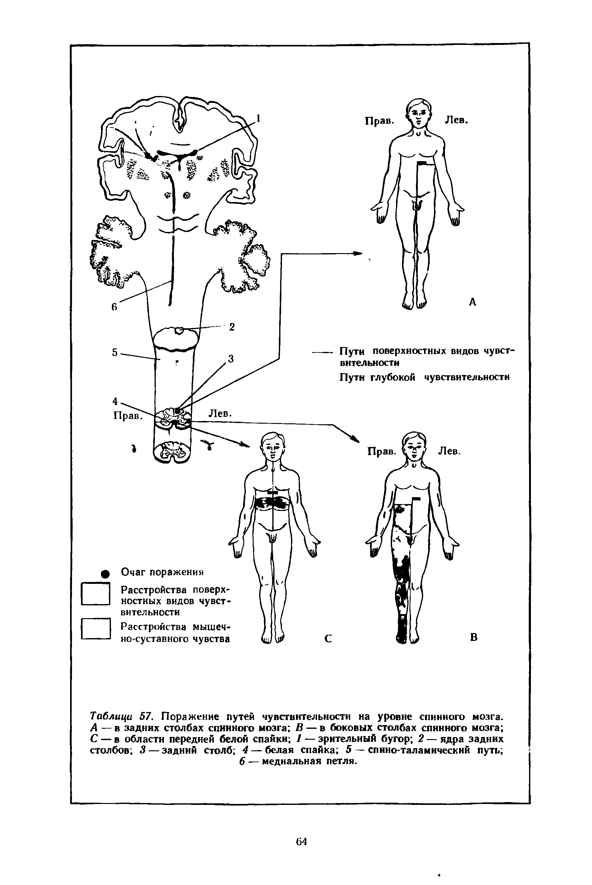 Таблица 57. Поражение путей чувствительности на уровне спинного мозга. А — в задних столбах спинного мозга В — в боковых столбах спинного мозга С — в области передней белой спайки 1 — зрительный бугор 2 — ядра задних столбов 3 — задний столб 4 — белая спайка 5 — спино-таламический путь ...