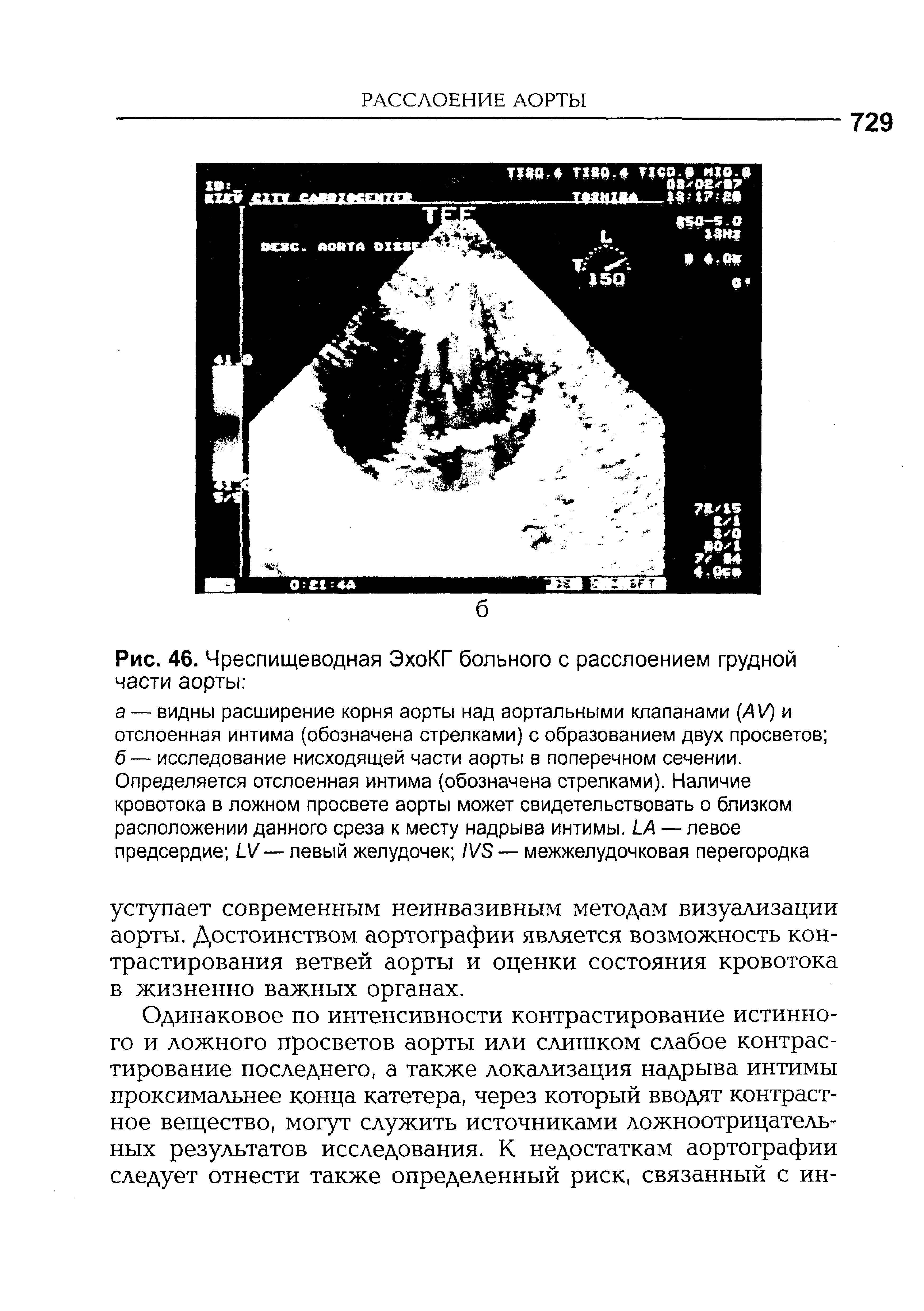 Рис. 46. Чреспищеводная ЭхоКГ больного с расслоением грудной части аорты ...