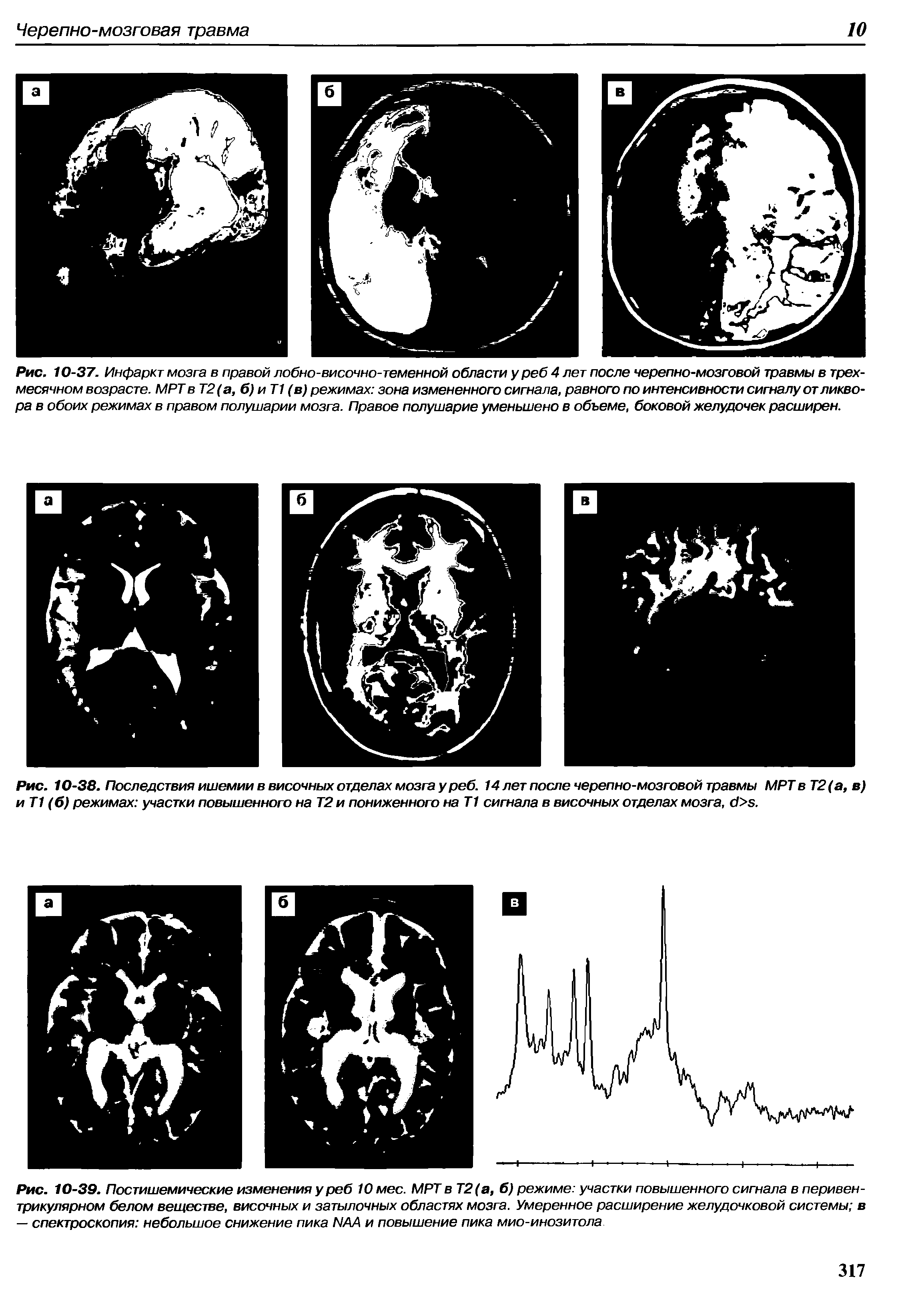 Рис. 10-39. Постишемические изменения у реб 10 мес. МРТ в Т2(а, б) режиме участки повышенного сигнала в перивен-трикулярном белом веществе, височных и затылочных областях мозга. Умеренное расширение желудочковой системы в — спектроскопия небольшое снижение пика NAA и повышение пика мио-инозитола...