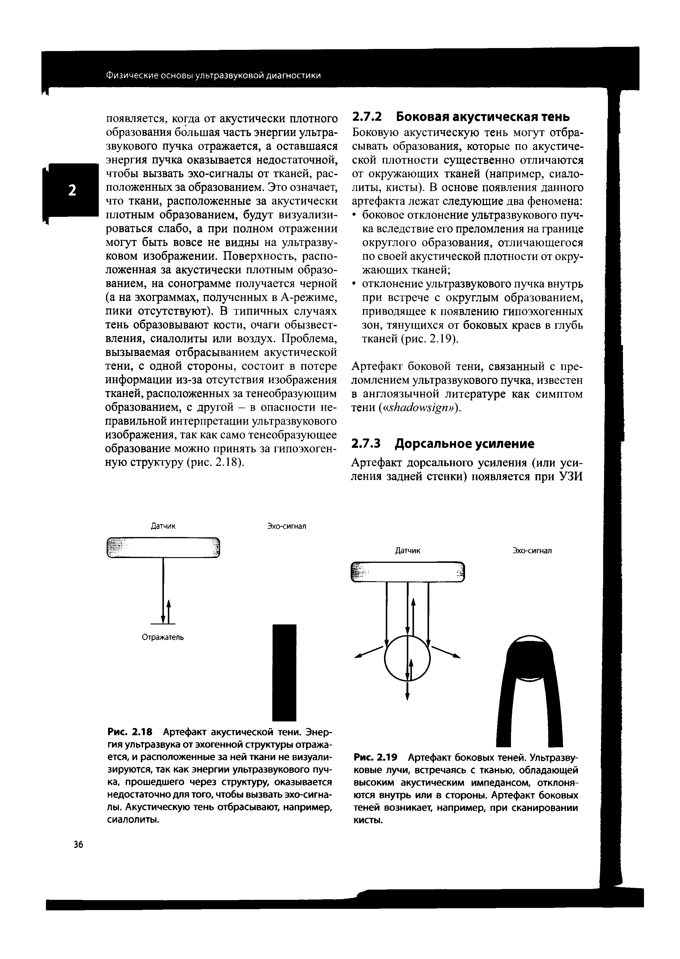 Рис. 2.18 Артефакт акустической тени. Энергия ультразвука от эхогенной структуры отражается, и расположенные за ней ткани не визуализируются, так как энергии ультразвукового пучка, прошедшего через структуру, оказывается недостаточно для того, чтобы вызвать эхо-сигналы. Акустическую тень отбрасывают, например, сиалолиты.