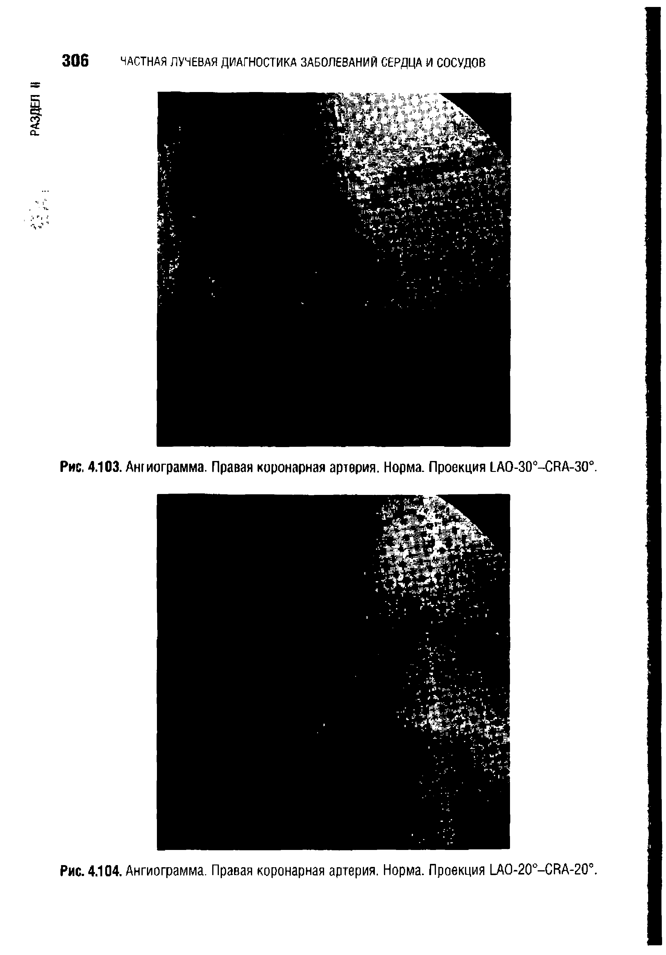 Рис. 4.104. Ангиограмма. Правая коронарная артерия. Норма. Проекция 1 АО-20°-СВА-20°.