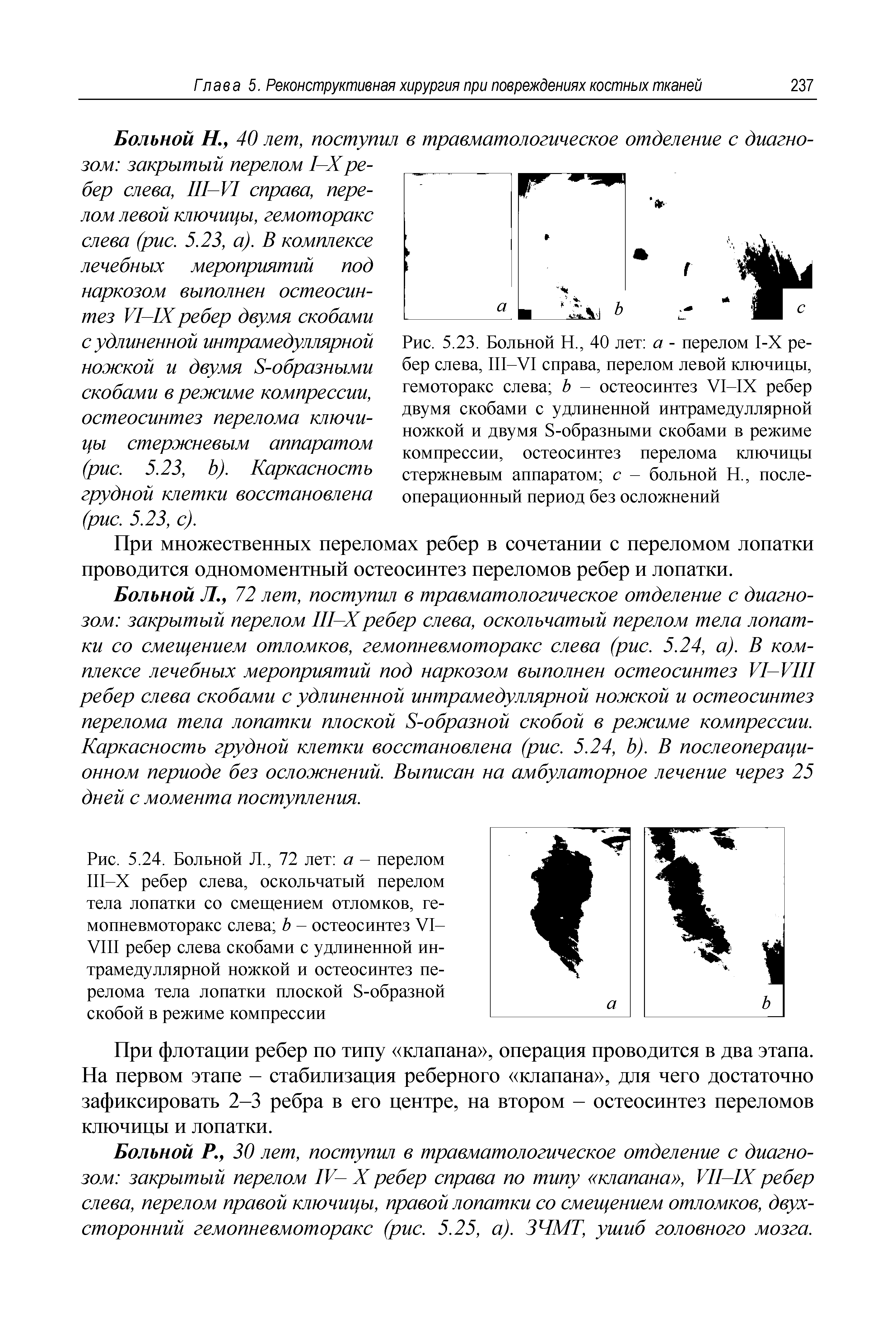Рис. 5.24. Больной Л., 72 лет а - перелом Ш-Х ребер слева, оскольчатый перелом тела лопатки со смещением отломков, гемопневмоторакс слева Ъ - остеосинтез VI-VIII ребер слева скобами с удлиненной интрамедуллярной ножкой и остеосинтез перелома тела лопатки плоской S-образной скобой в режиме компрессии...