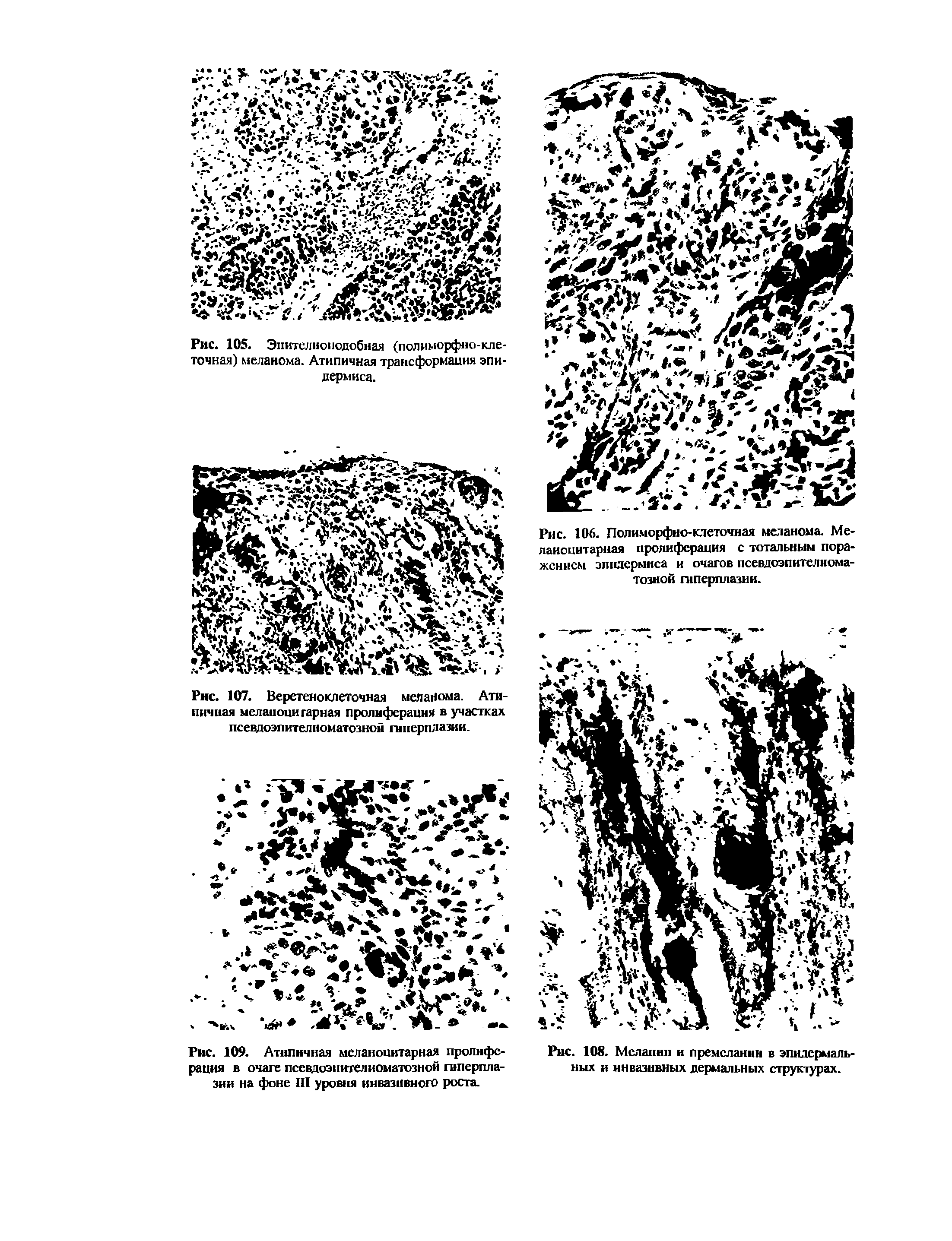 Рис. 106. Полиморфно-клеточная меланома. Меланоцитарная пролиферация с тотальным поражением эпидермиса и очагов псевдоэпителиома-тозиой гиперплазии.