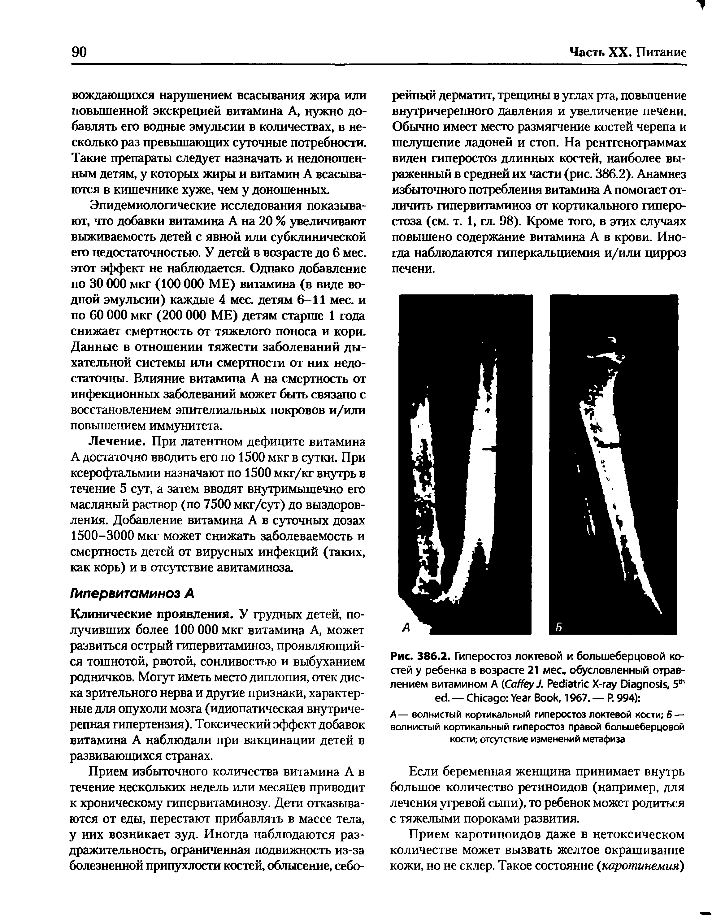 Рис. 386.2. Гиперостоз локтевой и большеберцовой костей у ребенка в возрасте 21 мес, обусловленный отравлением витамином A (C J. P X- D , 5,ь . — C Y B , 1967. — P. 994) ...