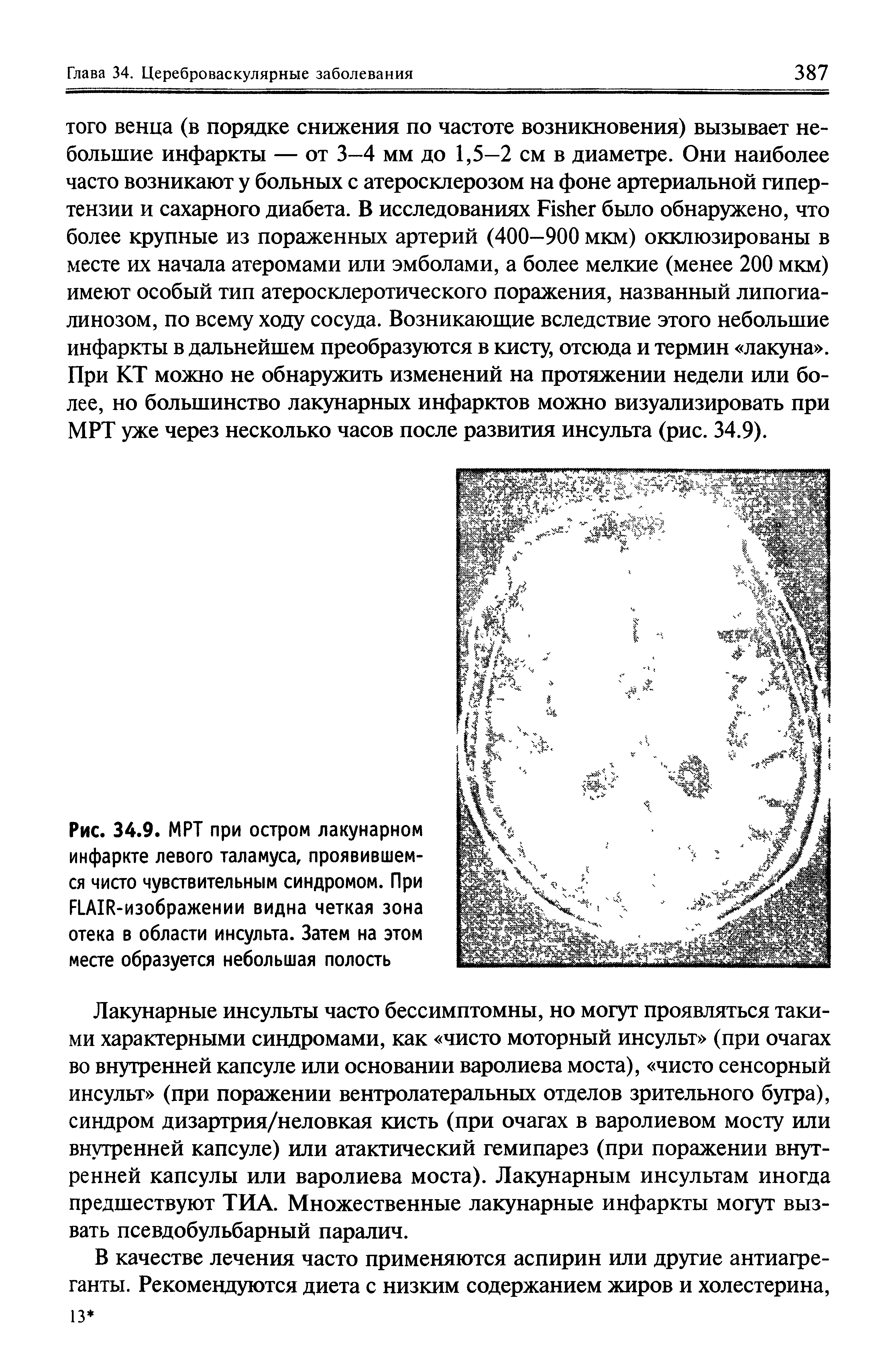 Рис. 34.9. МРТ при остром лакунарном инфаркте левого таламуса, проявившемся чисто чувствительным синдромом. При FLAIR-изображении видна четкая зона отека в области инсульта. Затем на этом месте образуется небольшая полость...