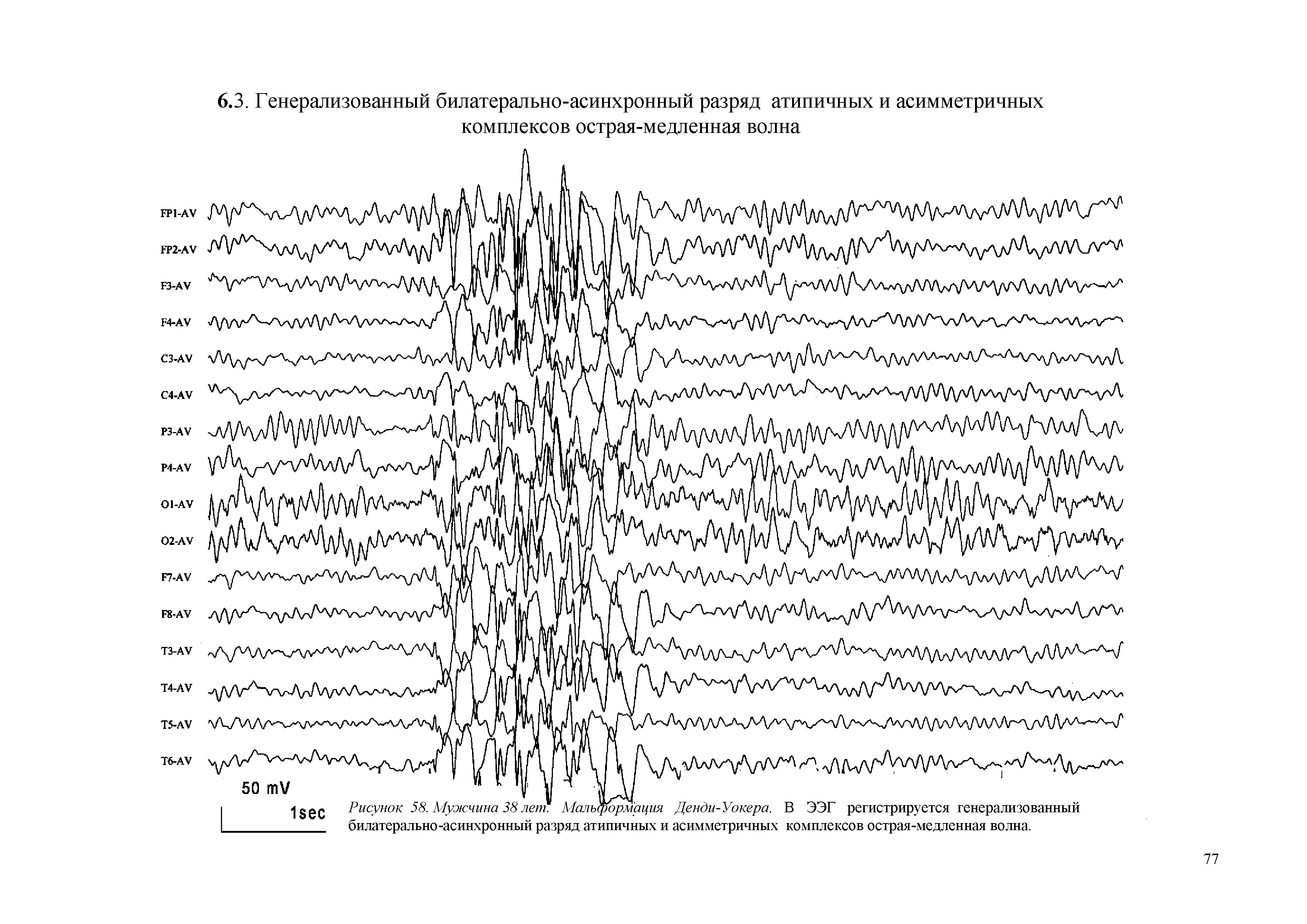 Рисунок 58. Мужчина 38 лет Мальформация Денди-Уокера. В ЭЭГ регистрируется генерализованный билатерально-асинхронный разряд атипичных и асимметричных комплексов острая-медленная волна.