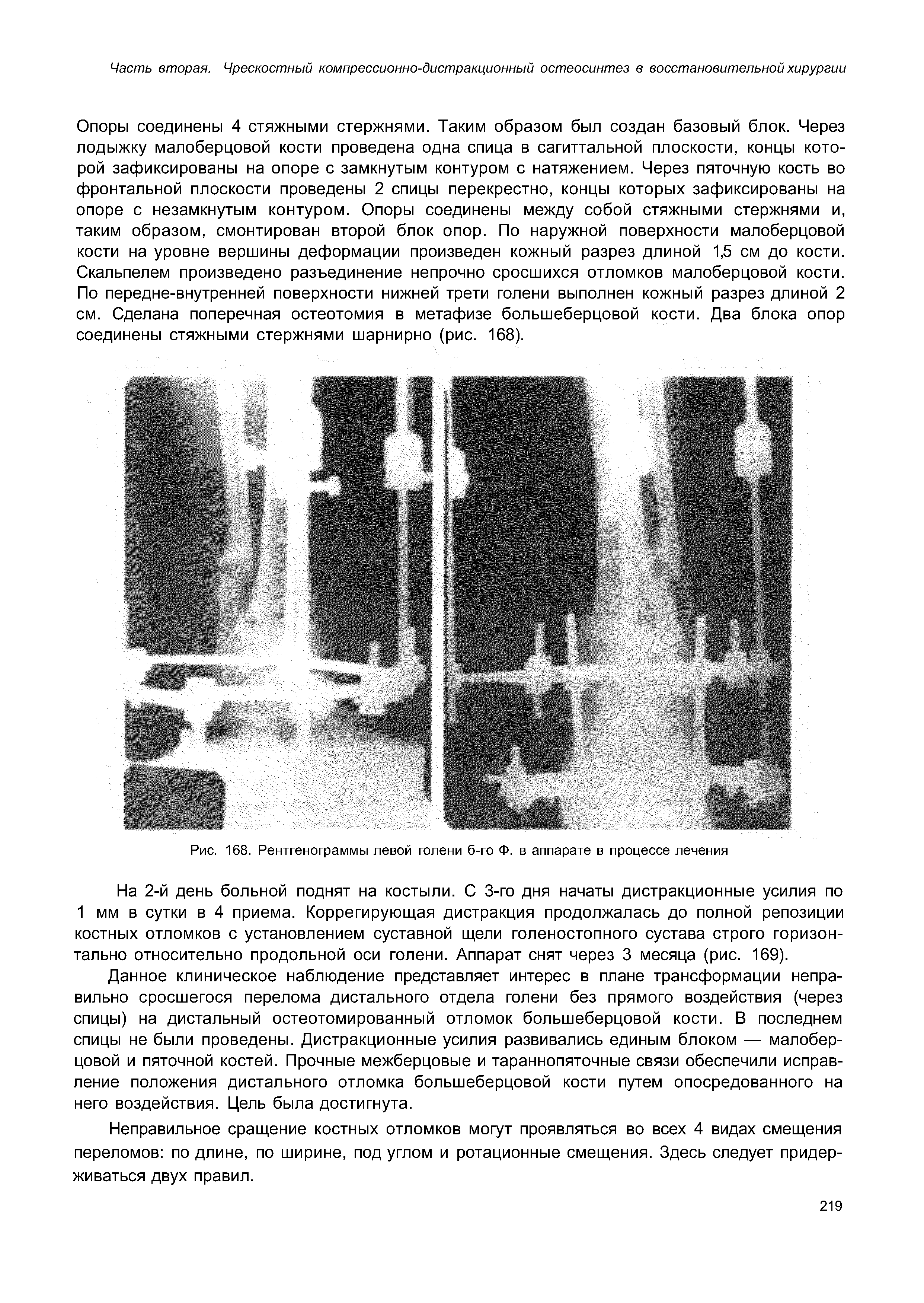 Рис. 168. Рентгенограммы левой голени б-го Ф. в аппарате в процессе лечения...