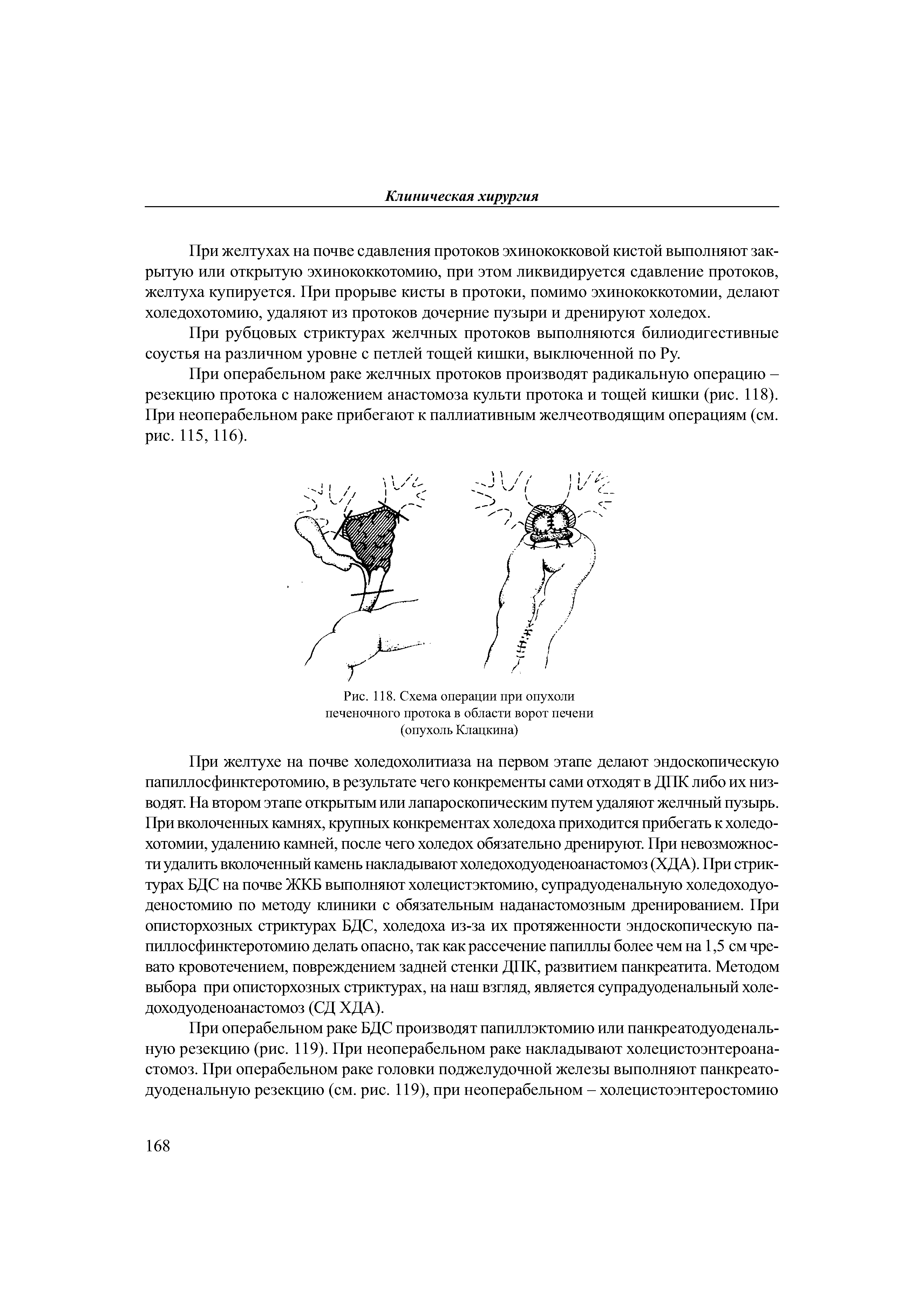 Рис. 118. Схема операции при опухоли печеночного протока в области ворот печени (опухоль Клацкина)...