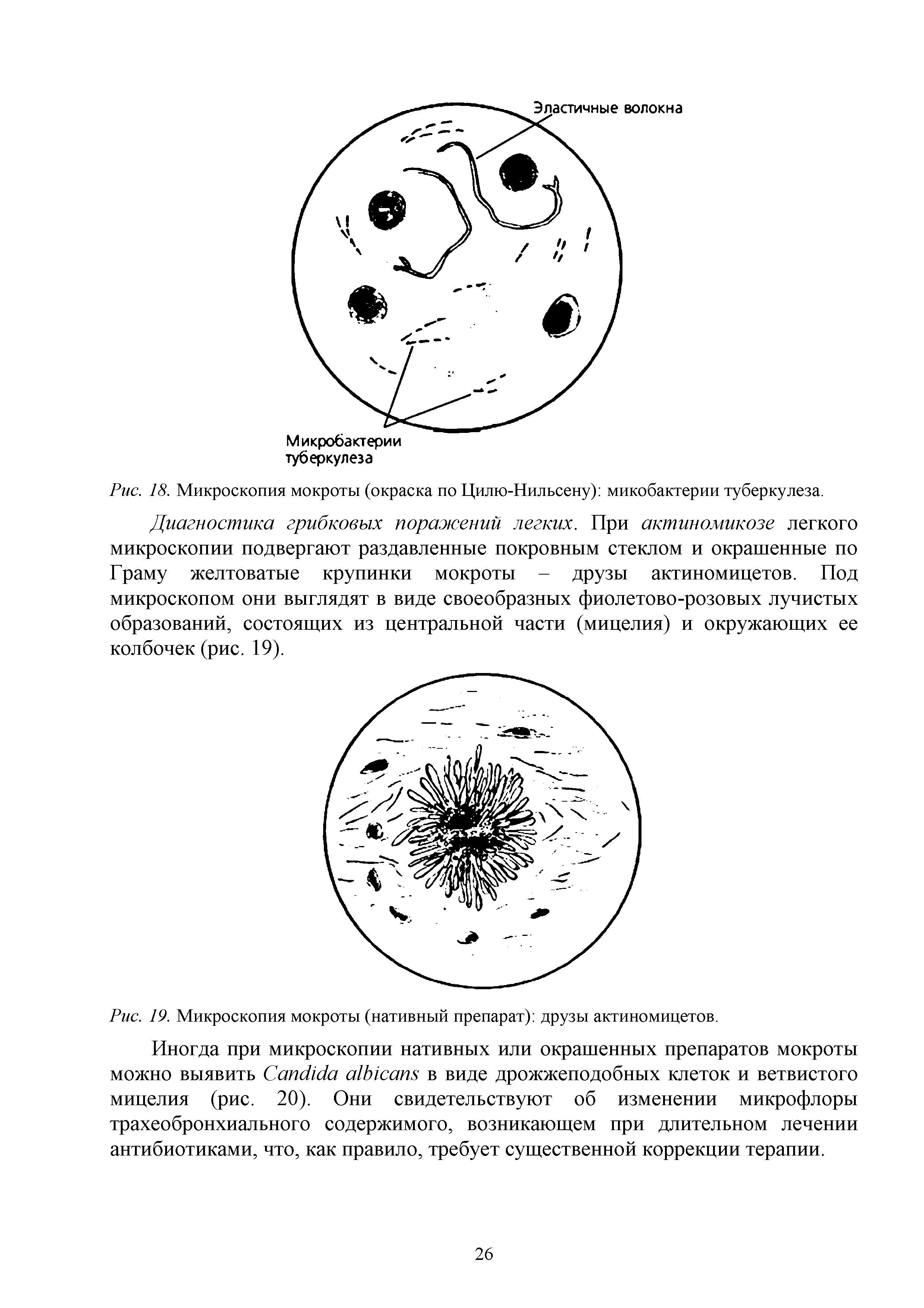 Рис. 19. Микроскопия мокроты (нативный препарат) друзы актиномицетов.