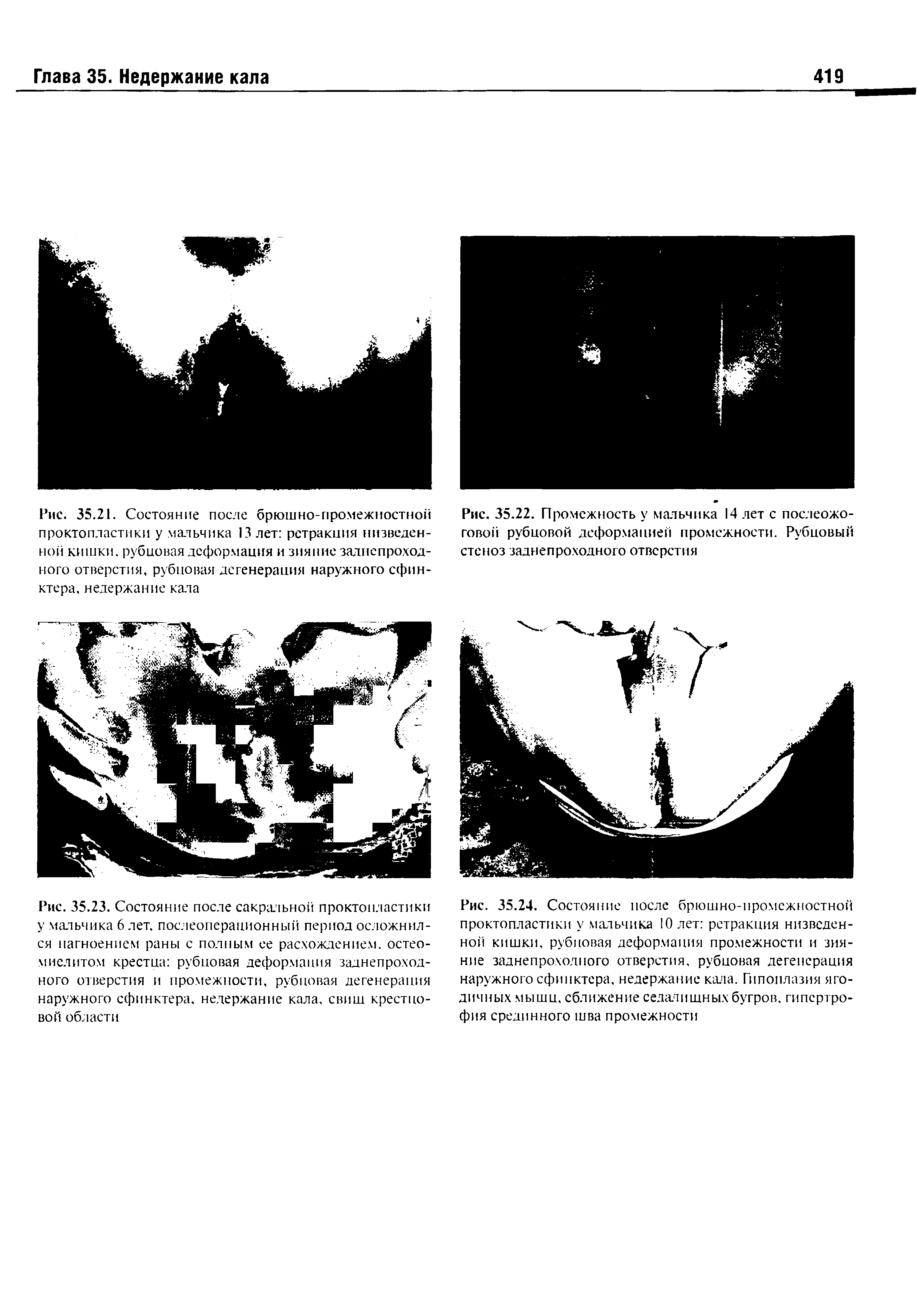 Рис. 35.24. Состояние после брюшно-нромежностной проктопластики у мальчика 10 лет ретракция низведенной кишки, рубцовая деформация промежности и зияние заднепроходного отверстия, рубцовая дегенерация наружного сфинктера, недержание кала. Гипоплазия ягодичных мышц, сближение седалищных бугров, гипертрофия срединного шва промежности...