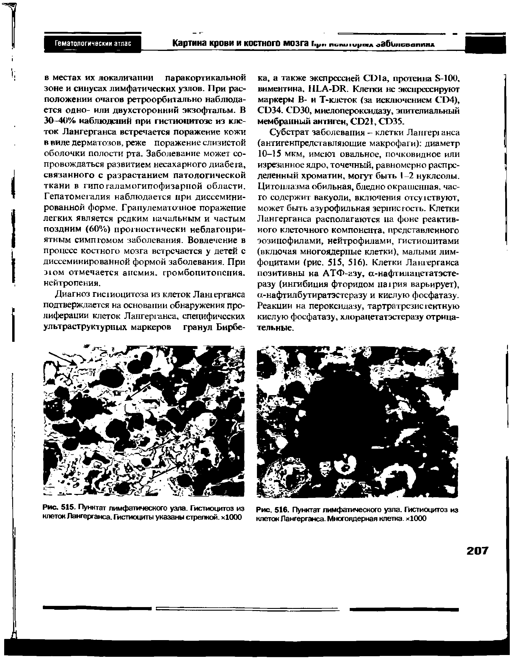 Рис. 515. Пунктат лимфатического узла. Гистиоцитоз из клеток Лангерганса. Гистиоциты указаны стрелкой. х1000...