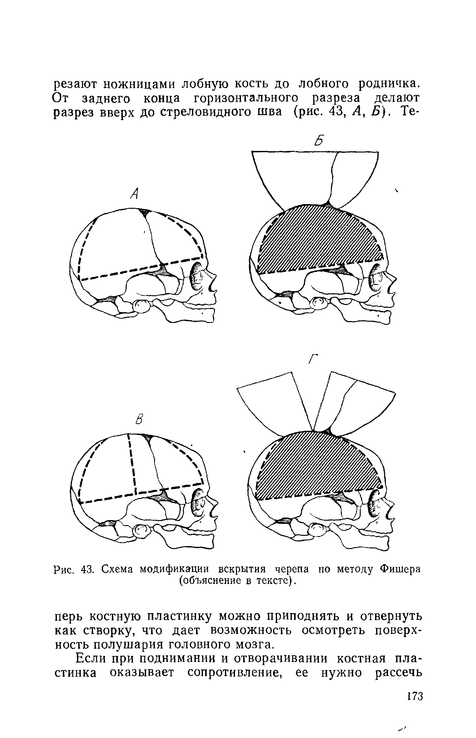 Рис. 43. Схема модификации вскрытия черепа по методу Фишера (объяснение в тексте).