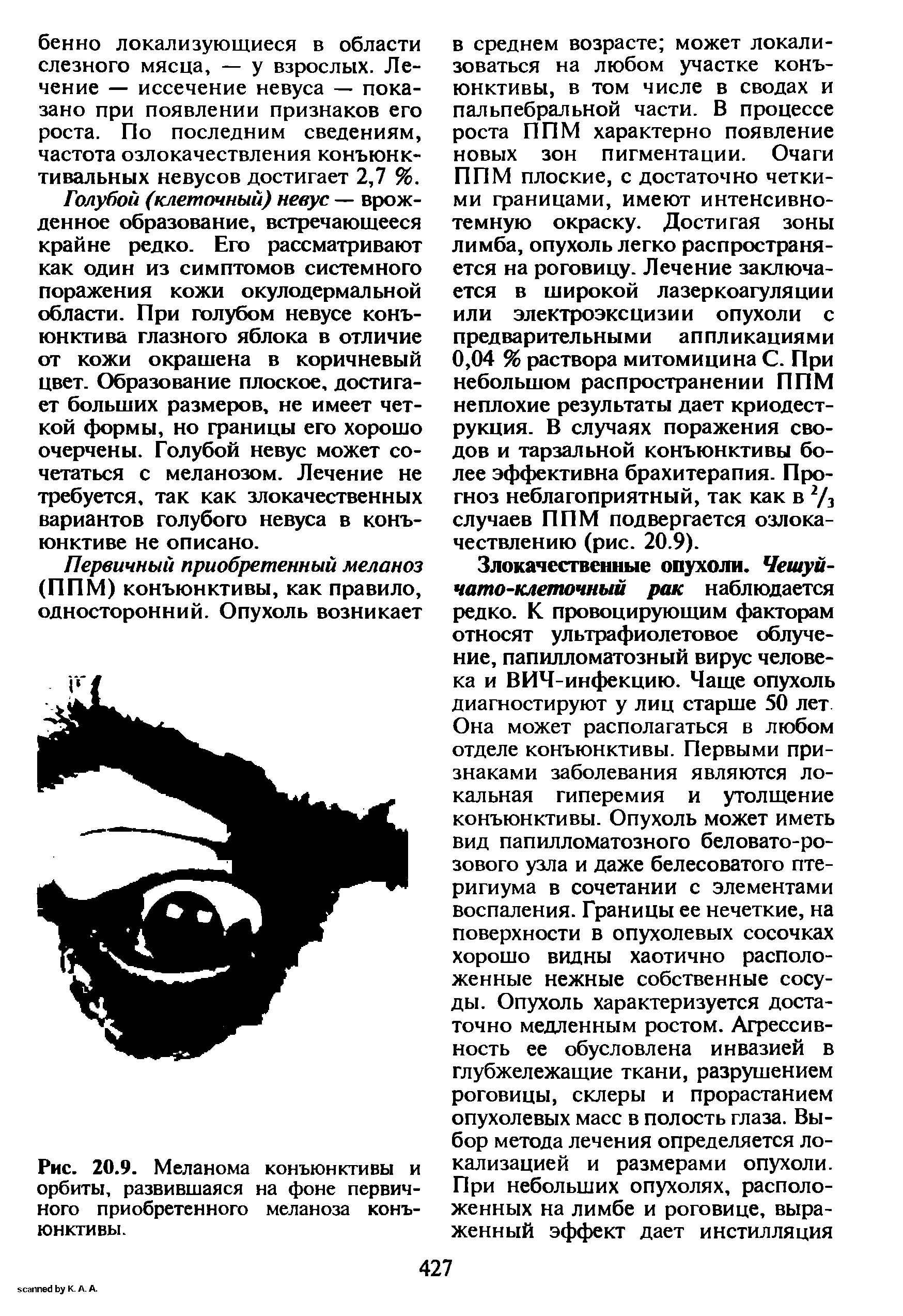 Рис. 20.9. Меланома конъюнктивы и орбиты, развившаяся на фоне первичного приобретенного меланоза конъюнктивы.