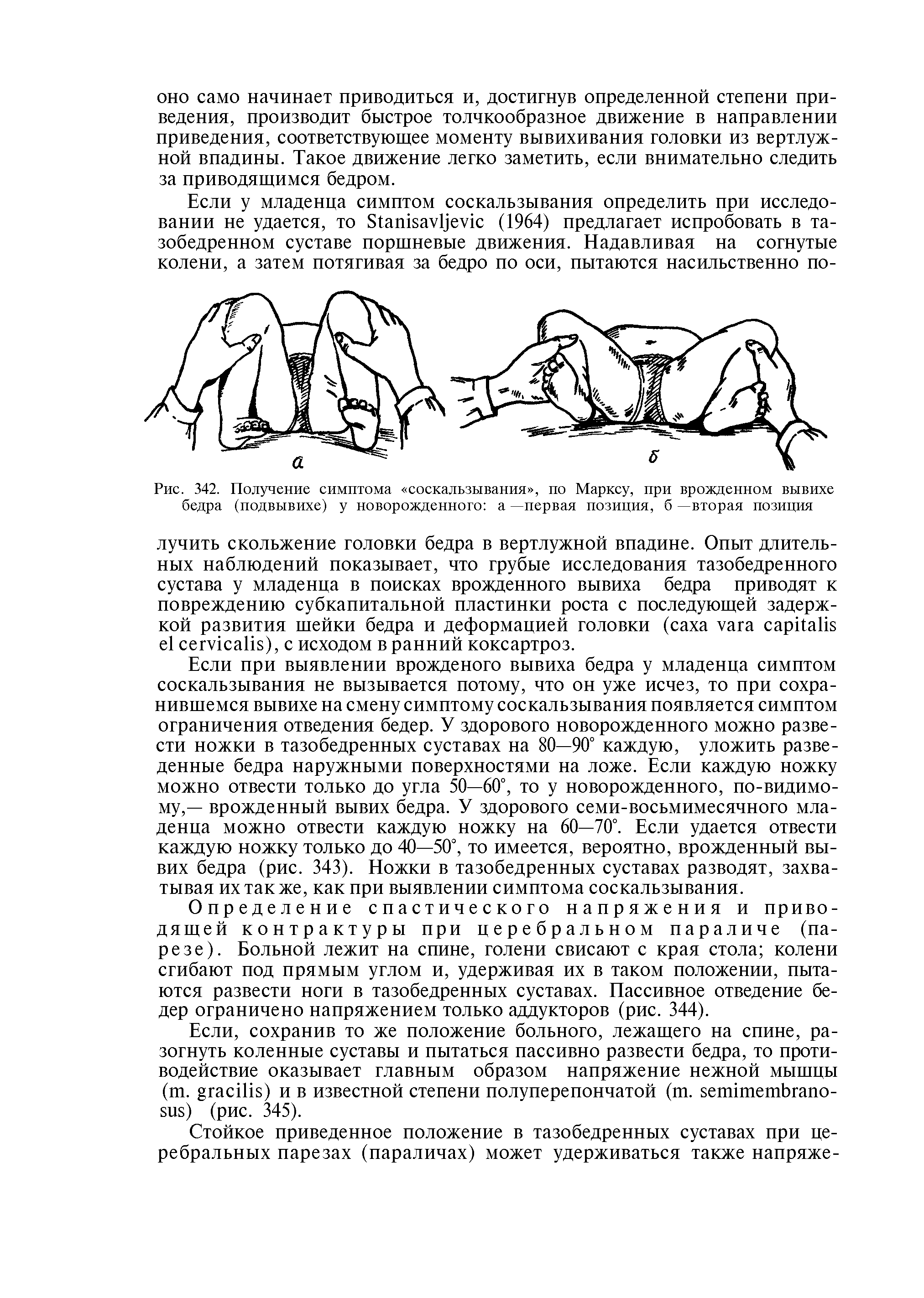 Рис. 342. Получение симптома соскальзывания , по Марксу, при врожденном вывихе бедра (подвывихе) у новорожденного а —первая позиция, б —вторая позиция...