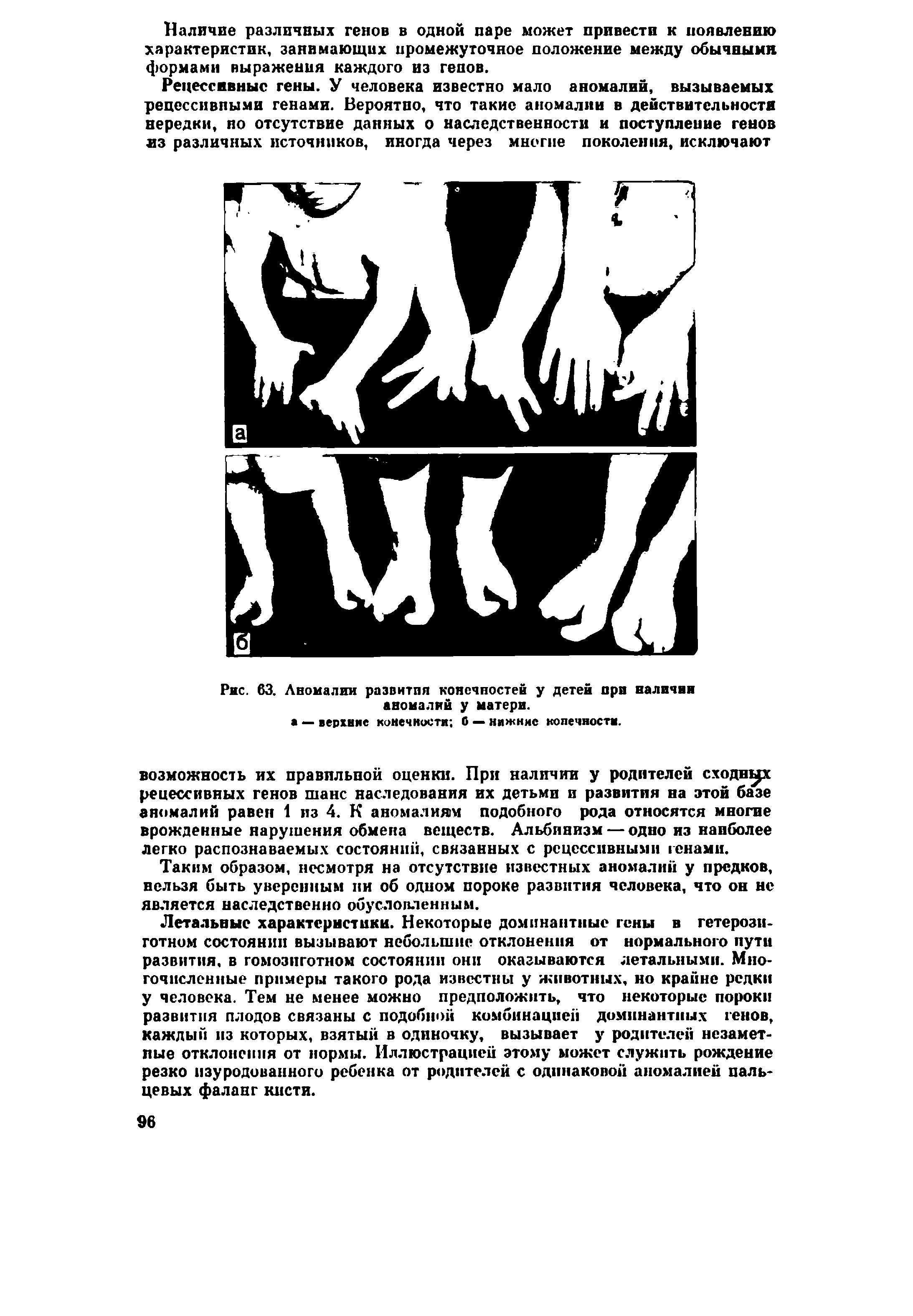 Рис. 63. Аномалии развития конечностей у детей при наличии аномалий у матери.