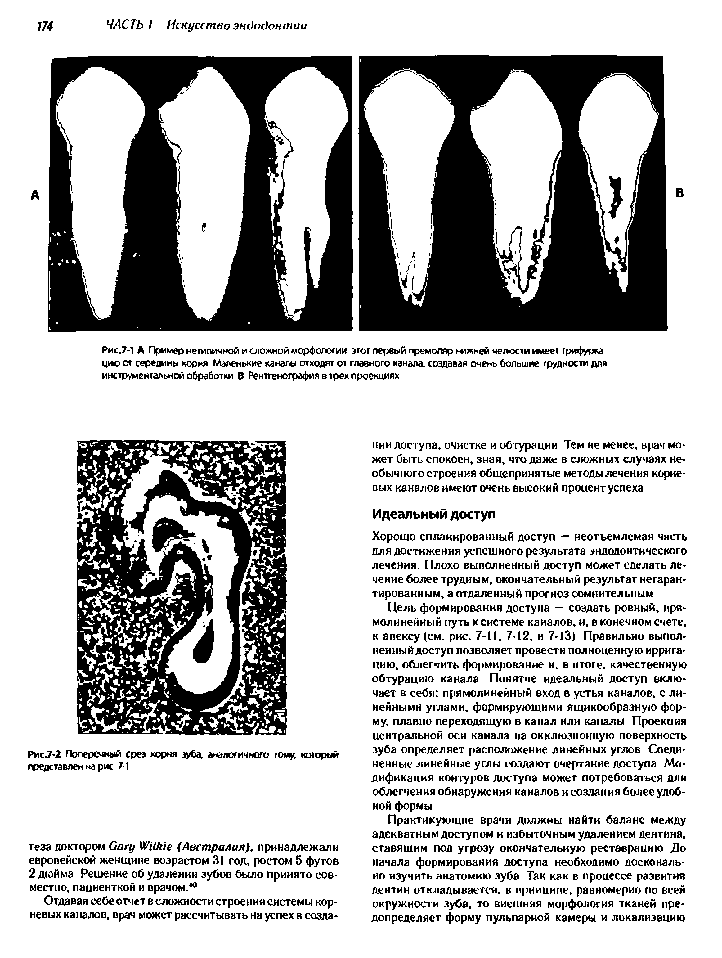 Рис.7-1 А Пример нетипичной и сложной морфологии этот первый премоляр нижней челюсти имеет трифурка цию от середины корня Маленькие каналы отходят от главного канала, создавая очень большие трудности для инструментальной обработки В Рентгенография в трех проекциях...