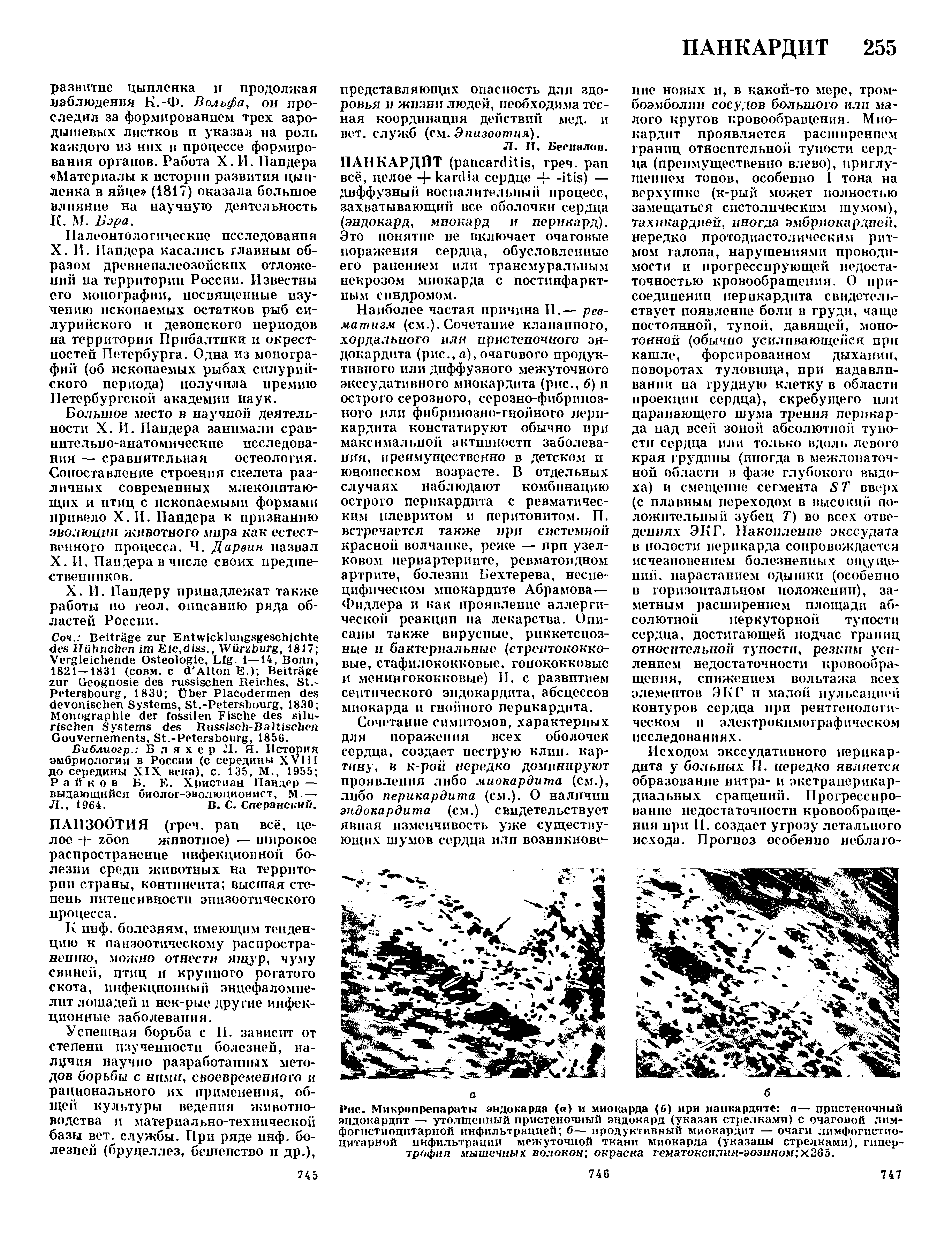 Рис. Микропрепараты эндокарда (а) и миокарда (б) при папкардите а— пристеночный эндокардит — утолщенный пристеночный эндокард (указан стрелками) с очаговой лим-фогистпоцитарной инфильтрацией б— продуктивный миокардит — очаги лимфогистио-цитарной инфильтрации межуточной ткани миокарда (указаны стрелками), гипертрофия мышечных волокон окраска гематоксплин-эознном х265.