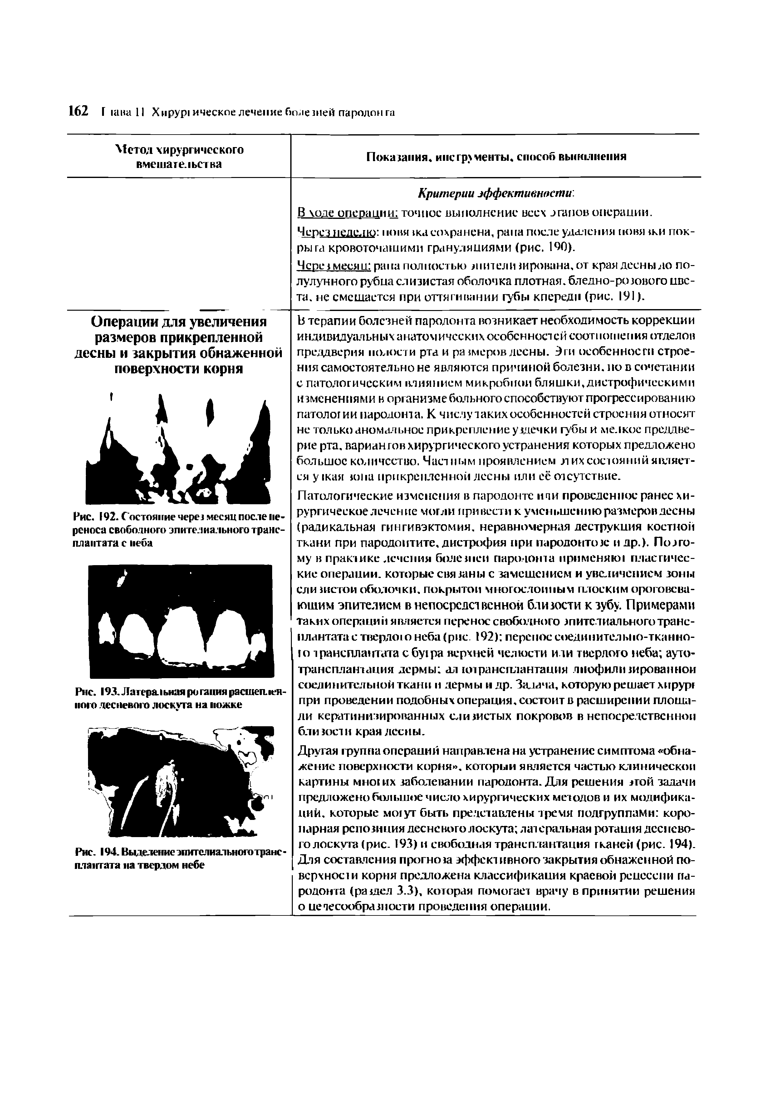 Рис. 193. Латеральная ротация растепленного десневого лоскута на ножке...