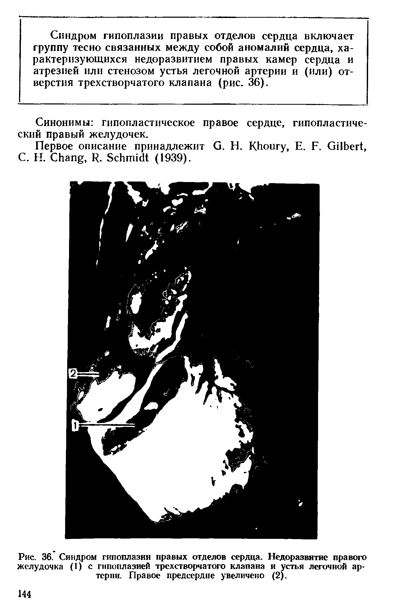 Рис. 36. Синдром гипоплазии правых отделов сержа. Недоразвитие правого желудочка (1) с гипоплазией трехстворчатого клапана и устья легочной артерии. Правое предсердие увеличено (2).