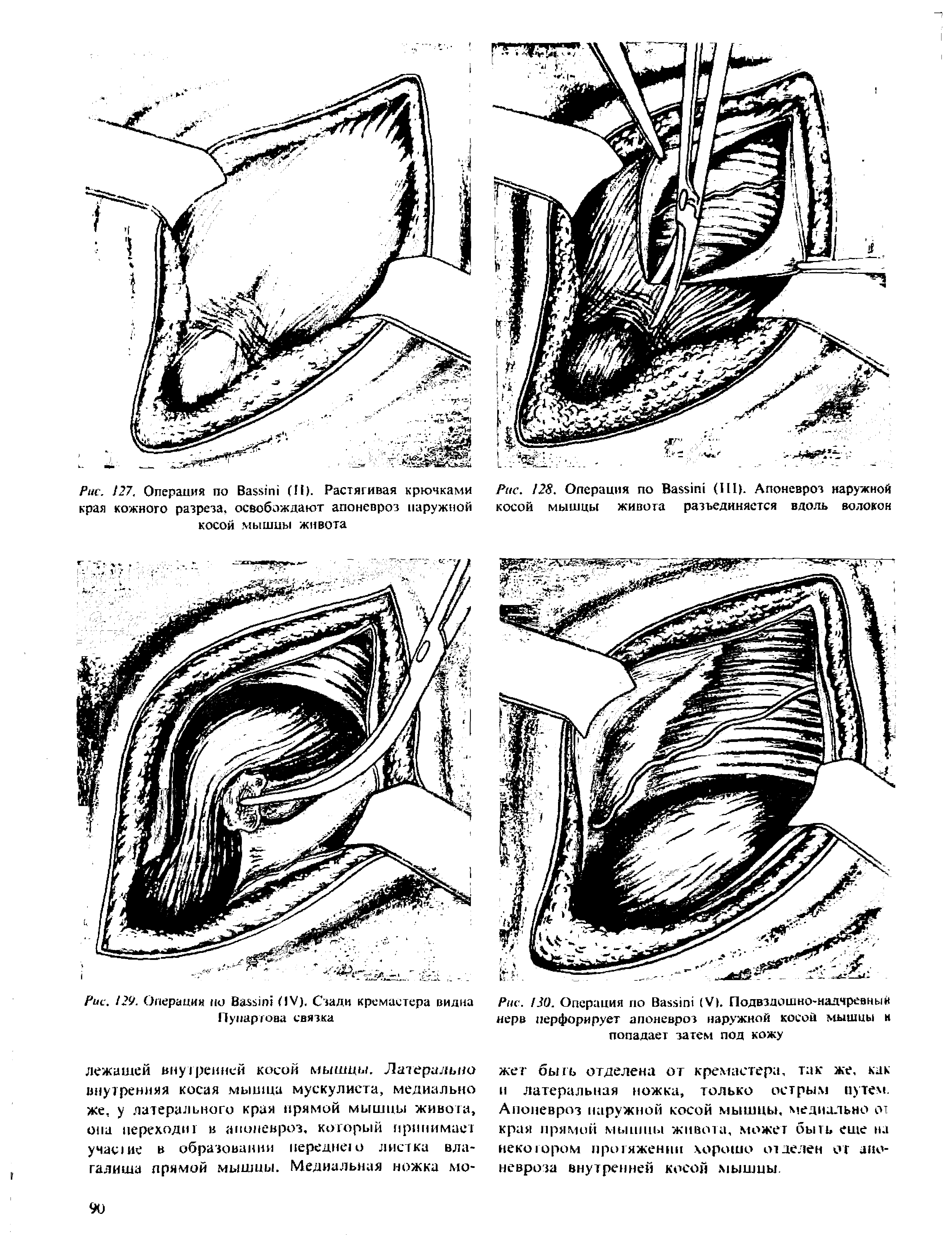 Рис. /20. Операция по B (V). Подвздошно-надчревный нерв перфорирует апоневроз наружной косой мышцы н попадает затем под кожу...