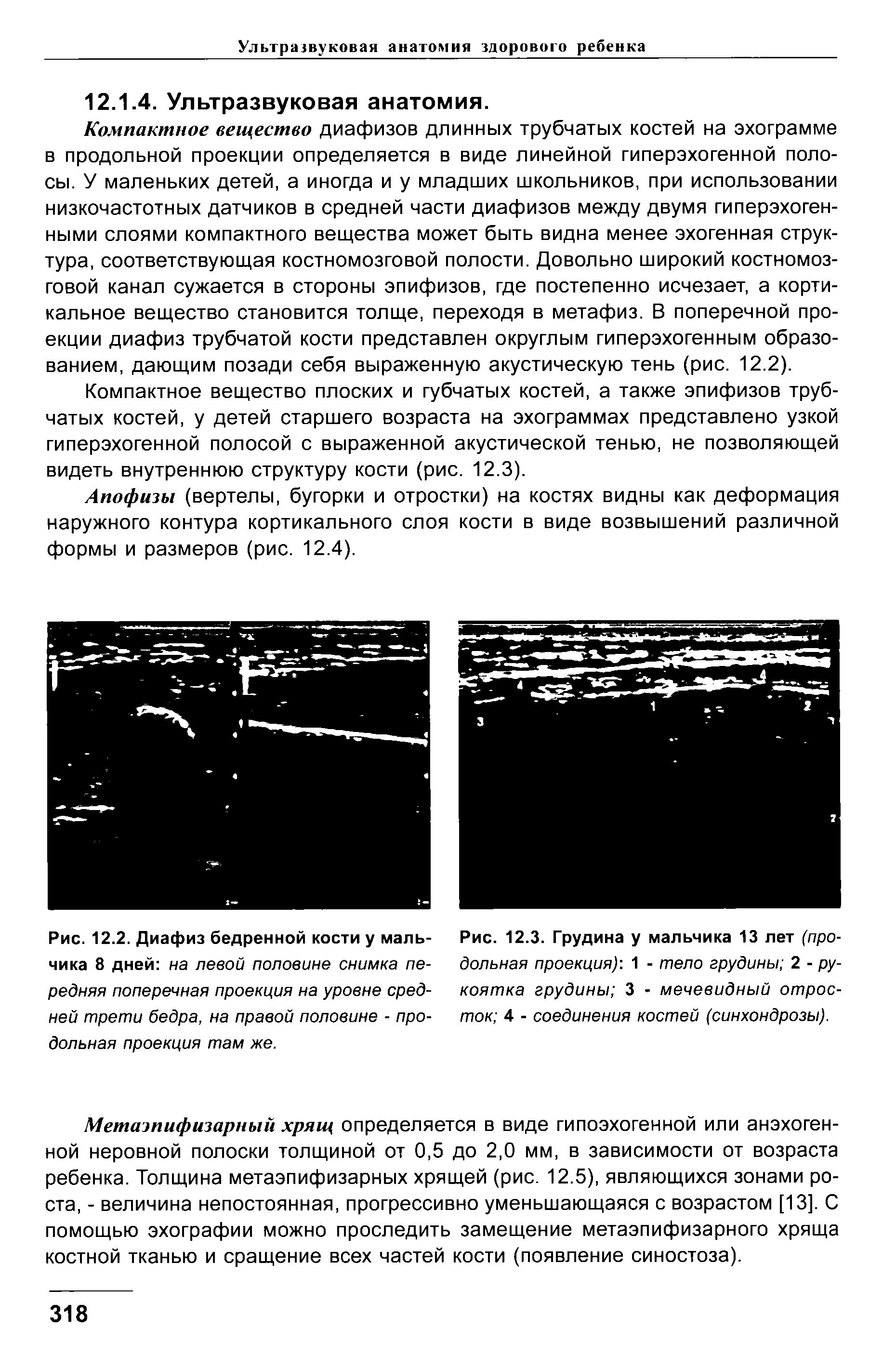 Рис. 12.3. Грудина у мальчика 13 лет (продольная проекция) 1 - тело грудины 2 - рукоятка грудины 3 - мечевидный отросток 4 - соединения костей (синхондрозы).