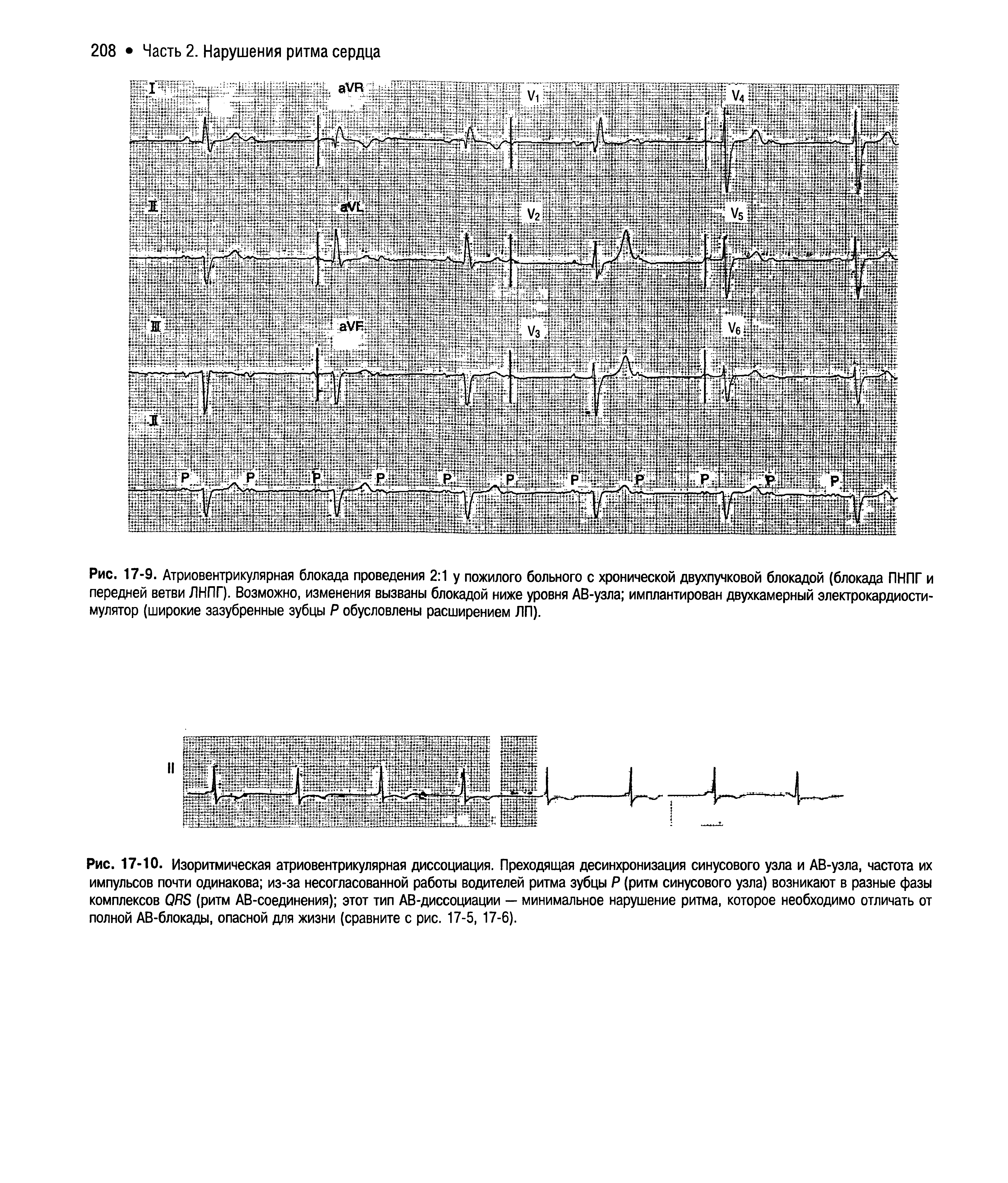 Рис. 17-9. Атриовентрикулярная блокада проведения 2 1 у пожилого больного с хронической двухпучковой блокадой (блокада ПНПГ и передней ветви ЛНПГ). Возможно, изменения вызваны блокадой ниже уровня АВ-узла имплантирован двухкамерный электрокардиостимулятор (широкие зазубренные зубцы Р обусловлены расширением ЛП).