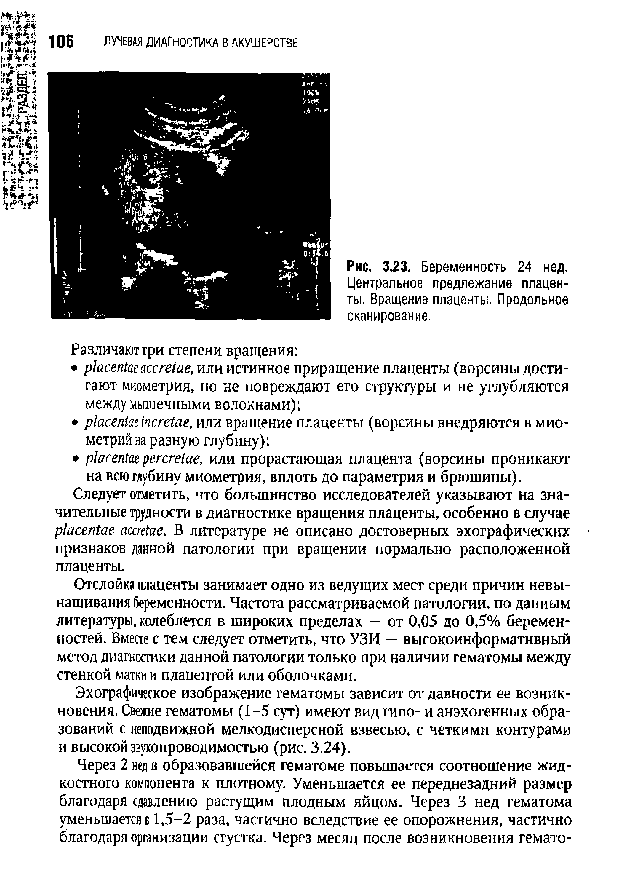 Рис. 3.23. Беременность 24 нед. Центральное предлежание плаценты. Вращение плаценты. Продольное сканирование.