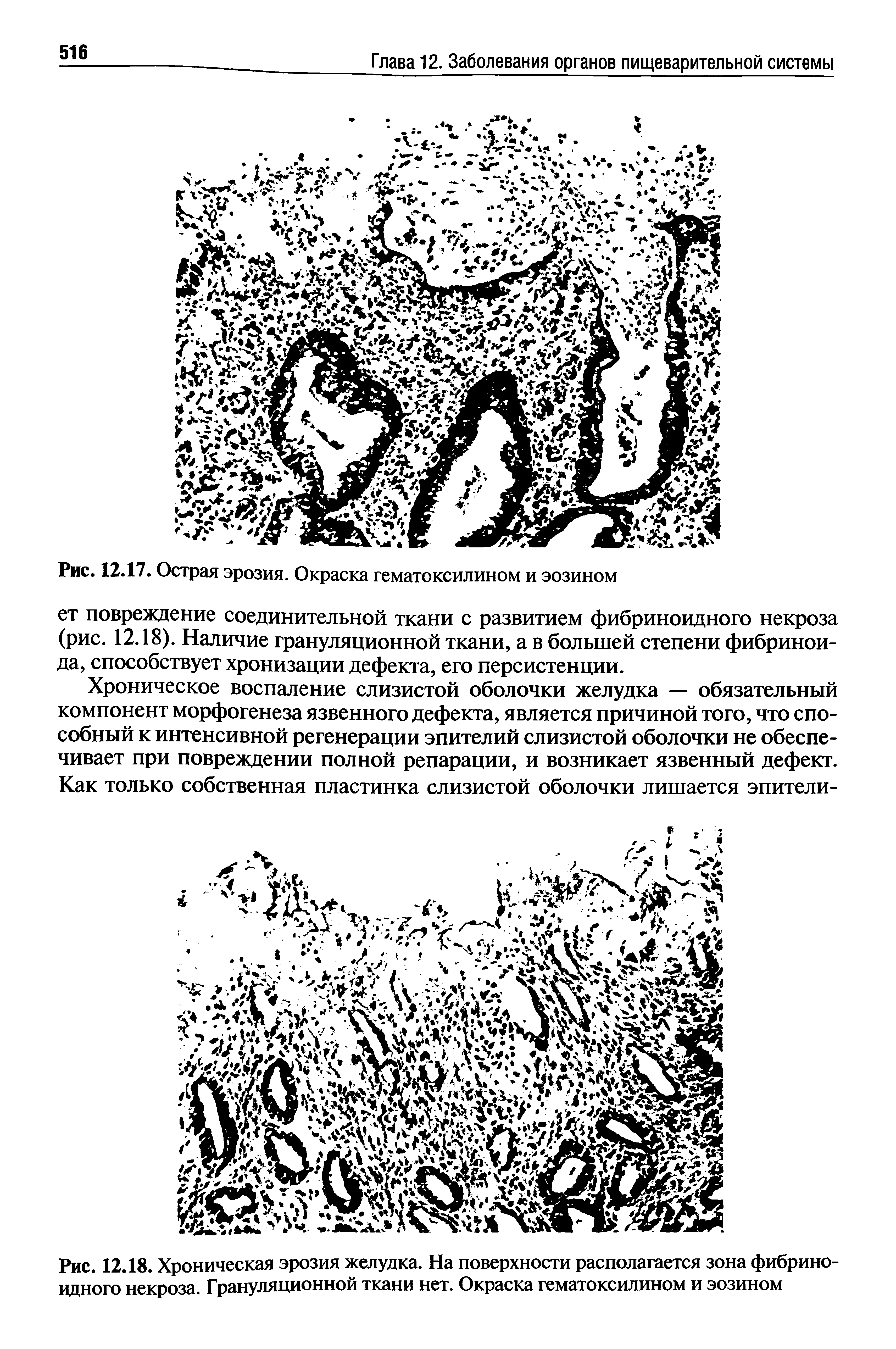 Рис. 12.18. Хроническая эрозия желудка. На поверхности располагается зона фибриноидного некроза. Грануляционной ткани нет. Окраска гематоксилином и эозином...