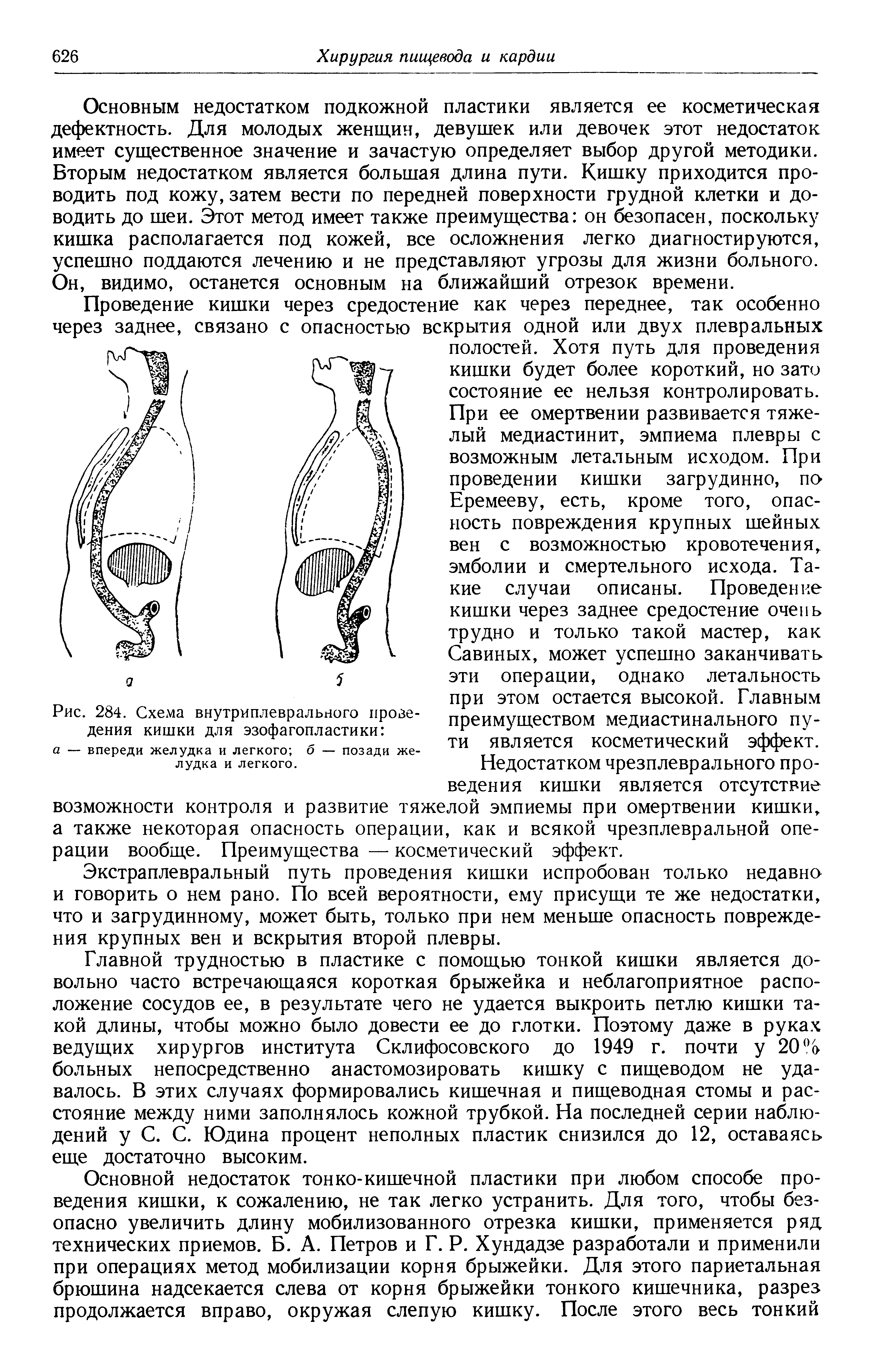 Рис. 284. Схема внутриплеврального проведения кишки для эзофагопластики а — впереди желудка и легкого б — позади желудка и легкого.