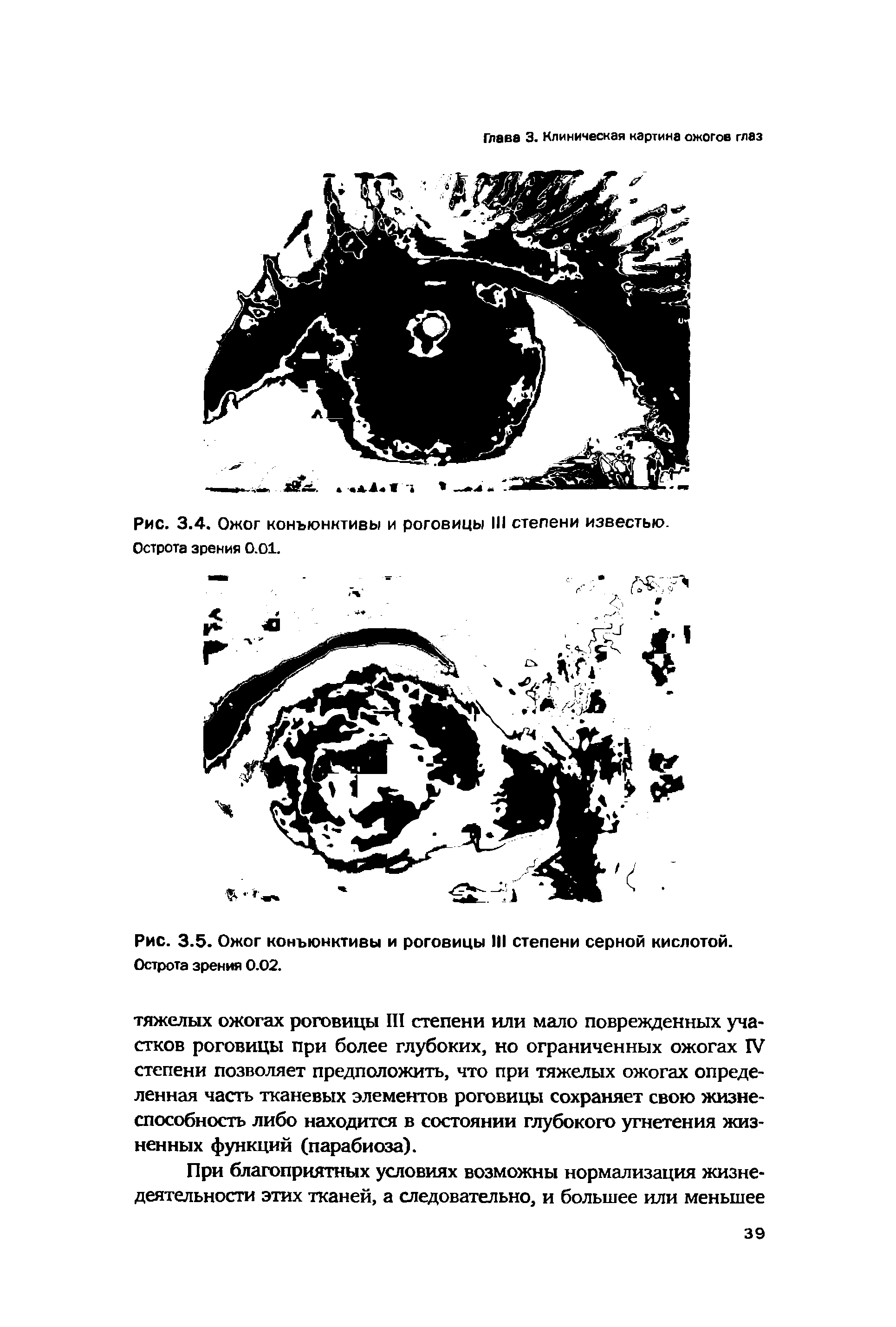 Рис. 3.5. Ожог конъюнктивы и роговицы III степени серной кислотой. Острота зрения 0.02.