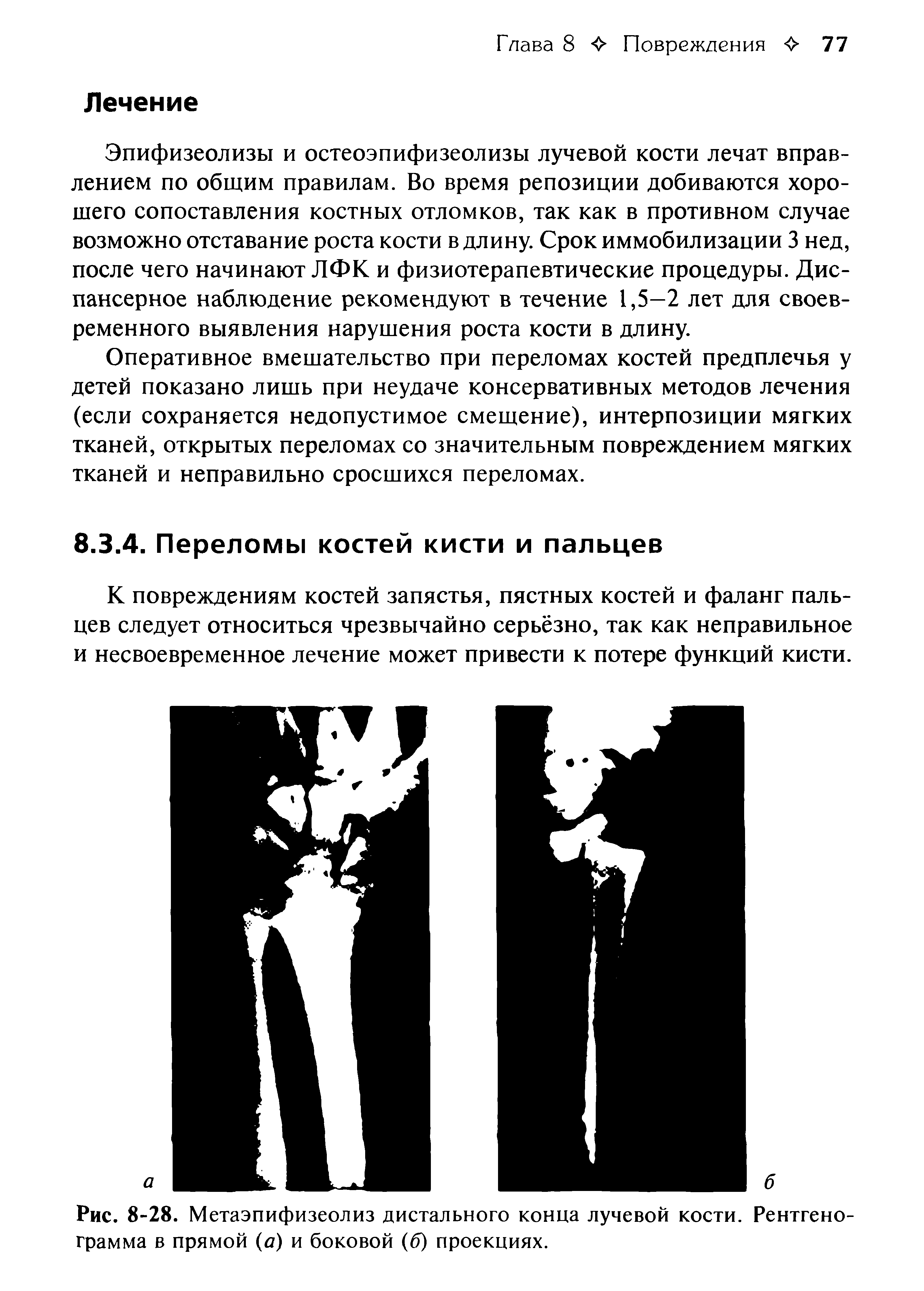 Рис. 8-28. Метаэпифизеолиз дистального конца лучевой кости. Рентгенограмма в прямой (а) и боковой (6) проекциях.