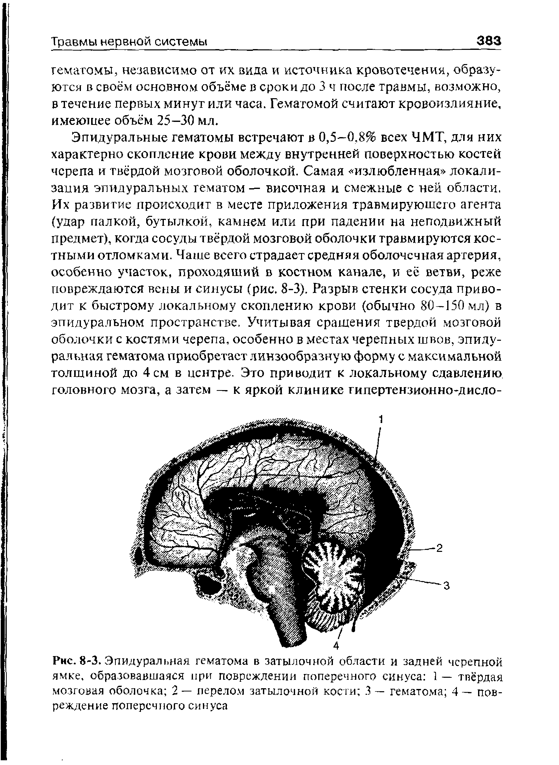 Рис. 8-3. Эпидуральная гематома в затылочной области и задней черепной ямке, образовавшаяся при повреждении поперечного синуса 1 — твёрдая мозговая оболочка 2 — перелом затылочной кости 3 — гематома 4— повреждение поперечного синуса...